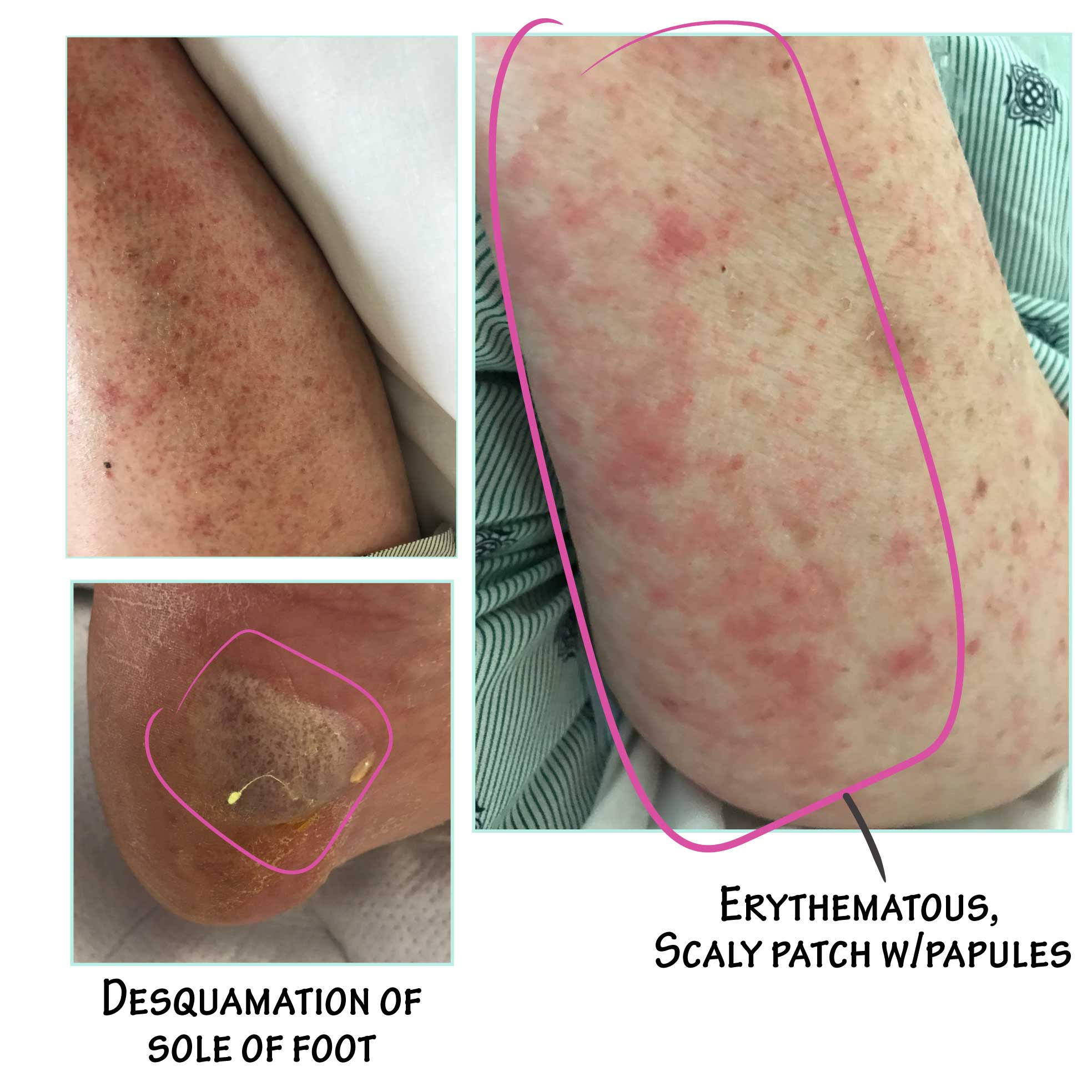 Eosinophilia Symptoms Biological Agent Successfully Treats