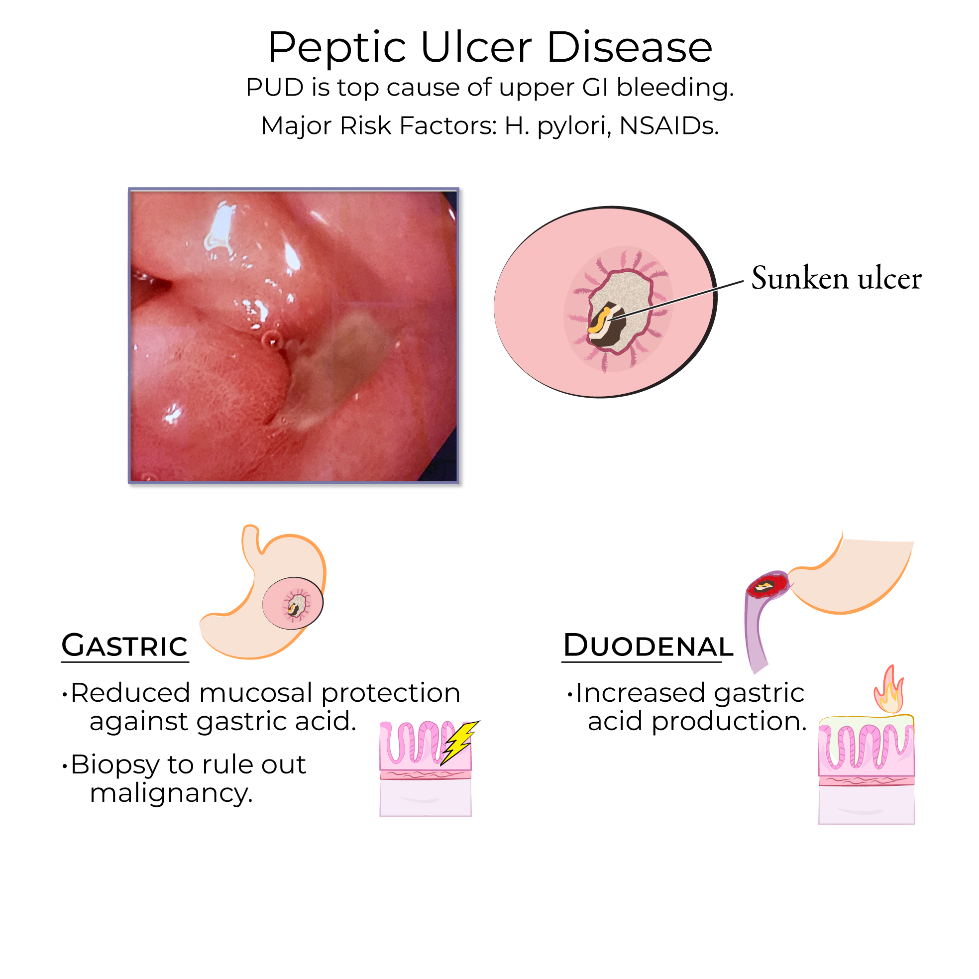 Peptic Ulcer Disease Symptoms Diagnosis Treatment