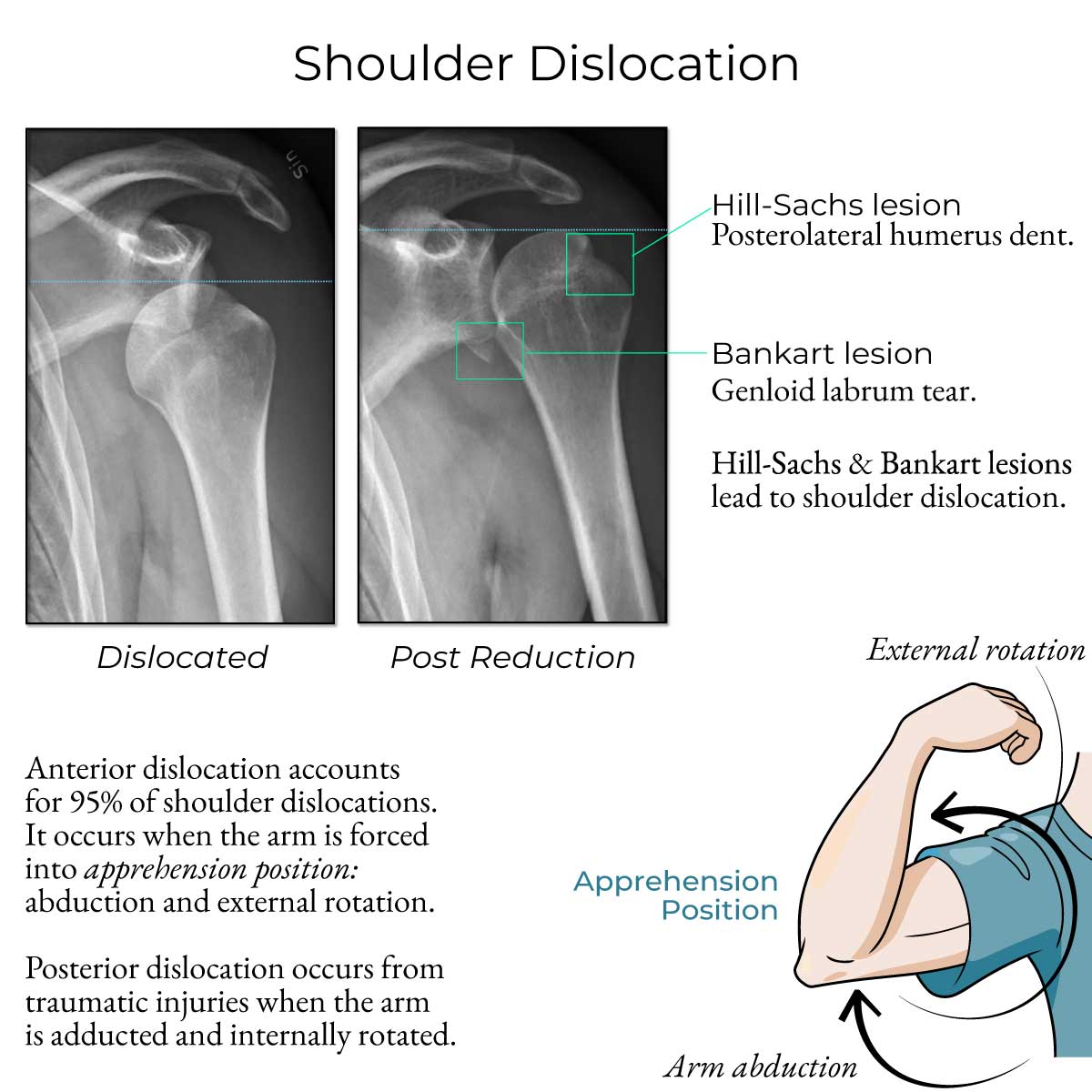 X Ray Shoulder Dislocation 89 Anterior Shoulder Dislocation Images X Ray Shoulder Dislocation 89 Anterior Shoulder Dislocation Images