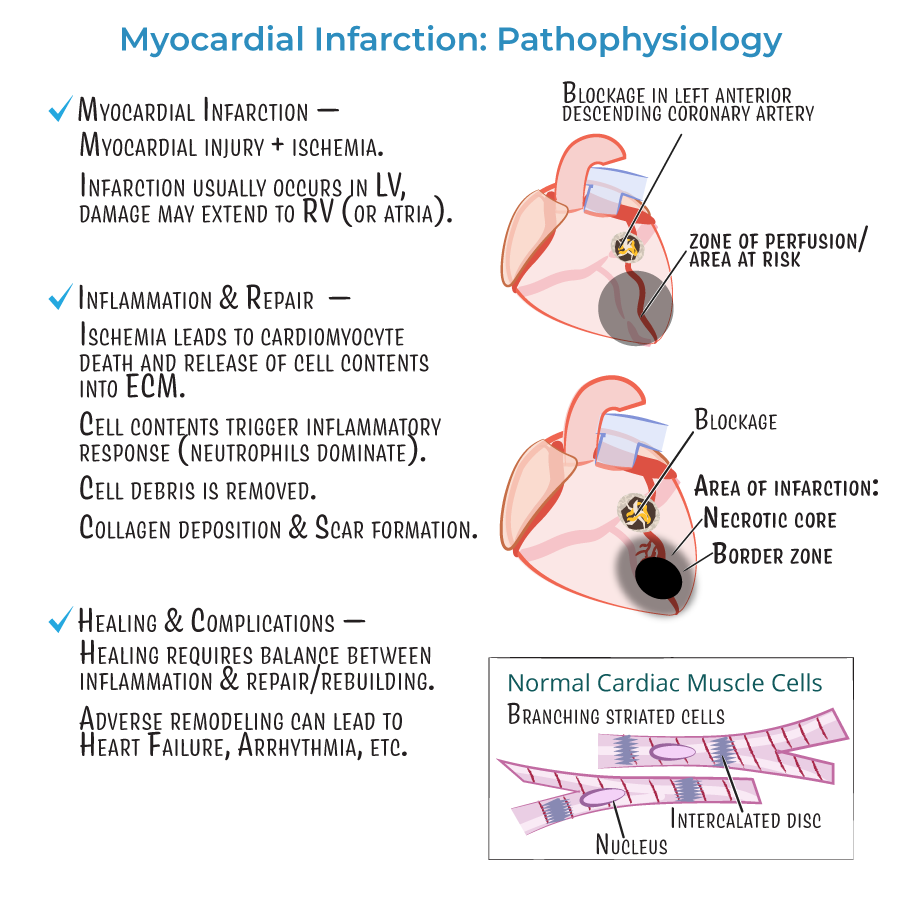 Acute Myocardial Infarction Pathophysiology