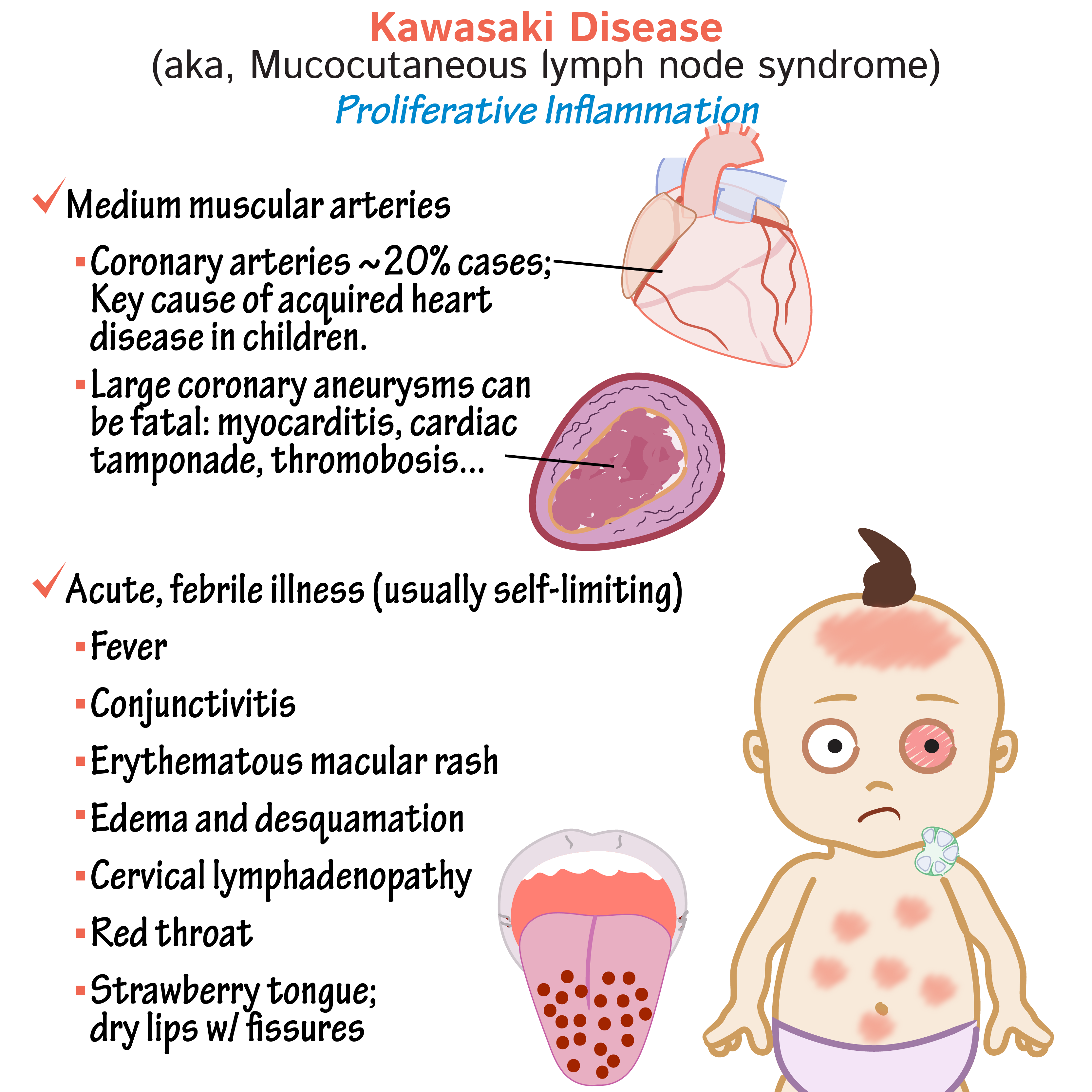 Kawasaki Disease Kawasaki Disease