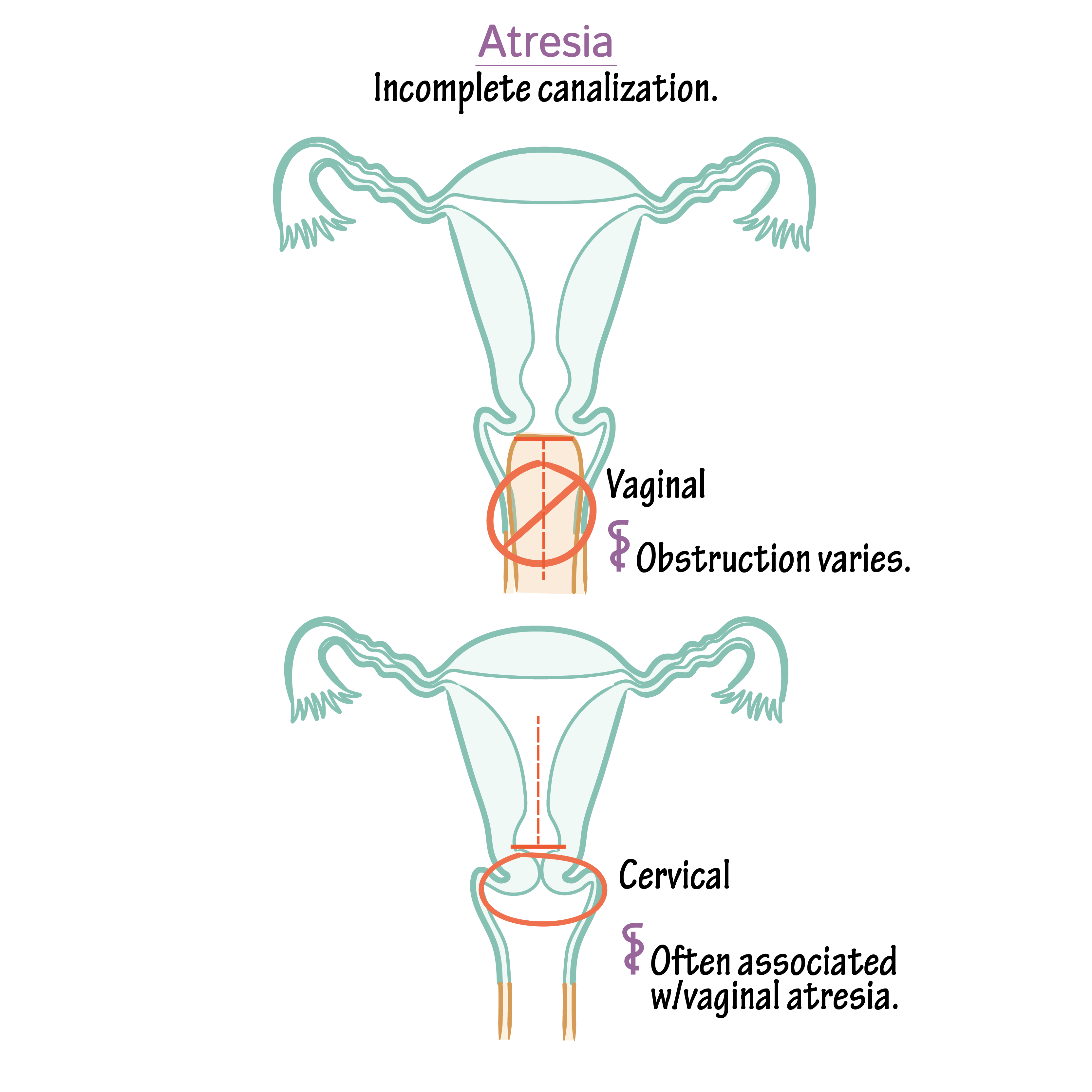 Embryology Glossary Congenital Vaginal & Cervical Atresia Draw It to
