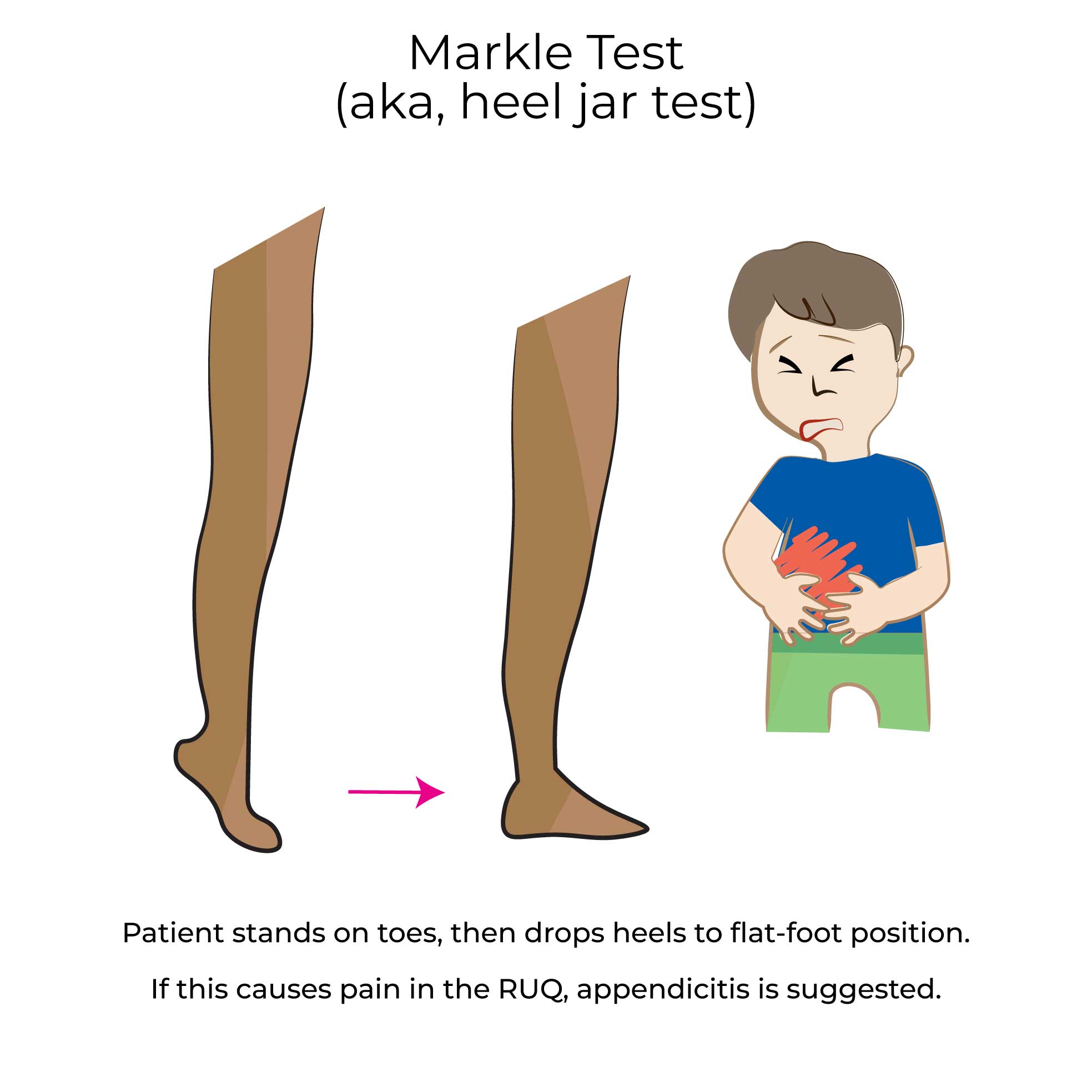 Markle Test (heel jar test)