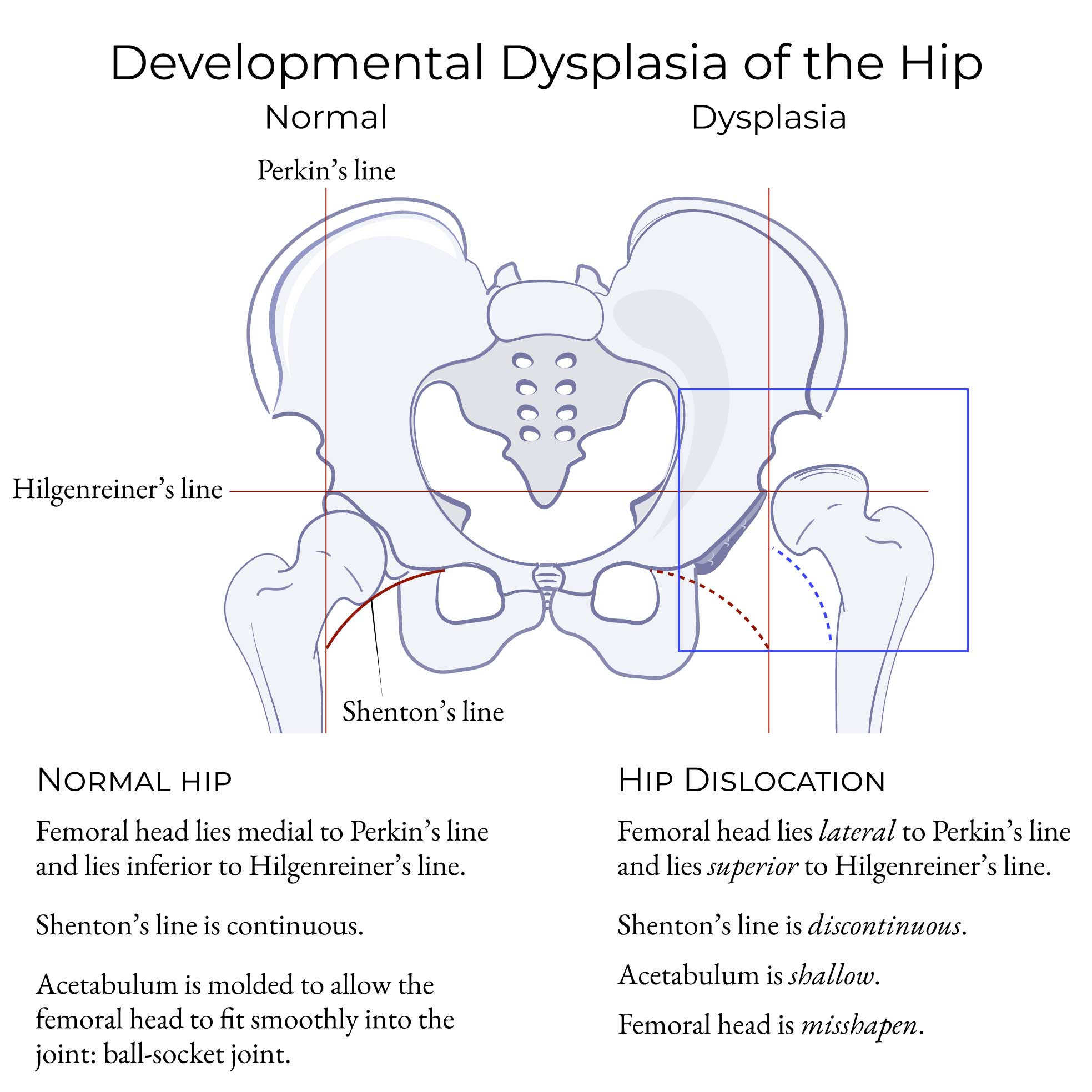Developmental Dysplasia of the Hip