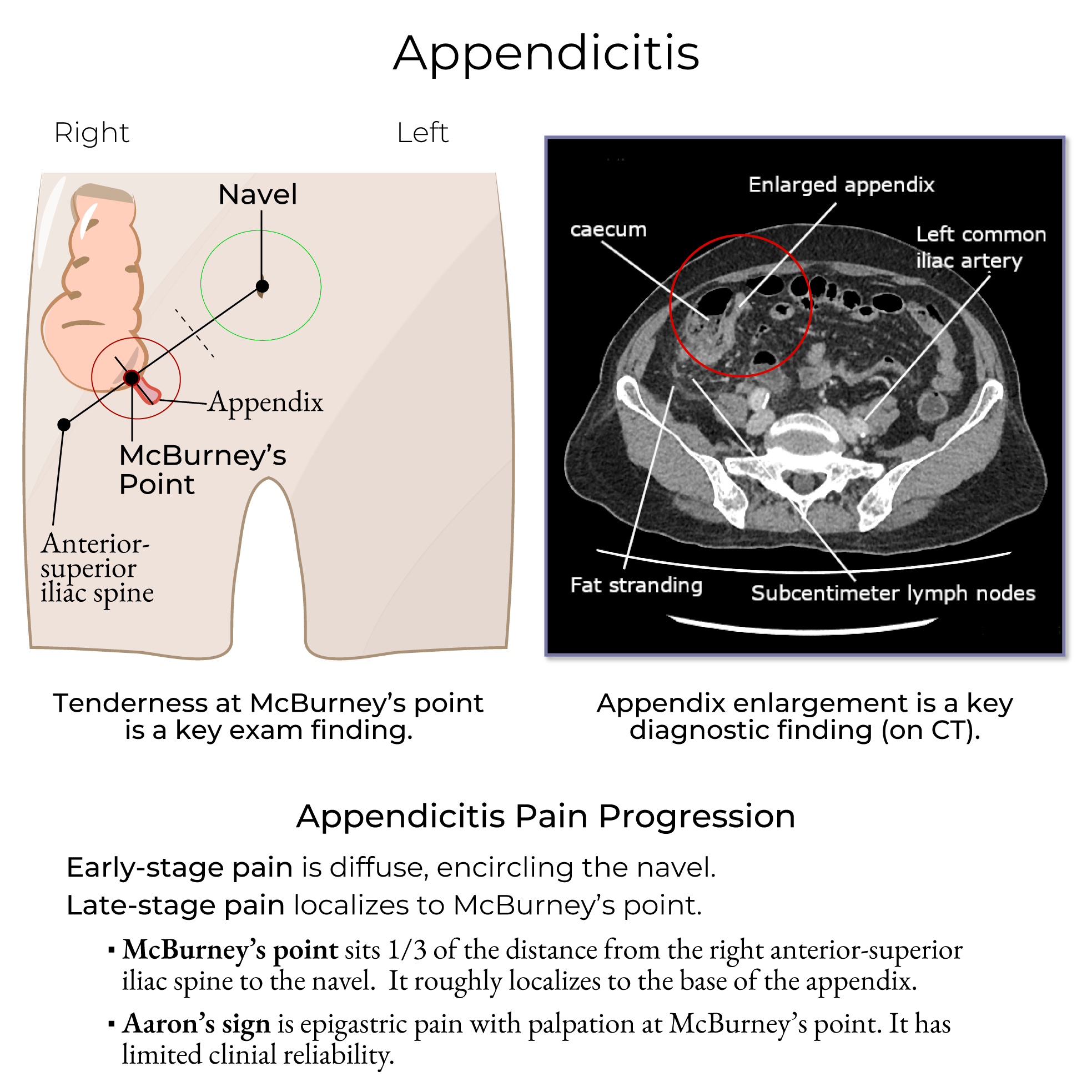 Appendicitis
