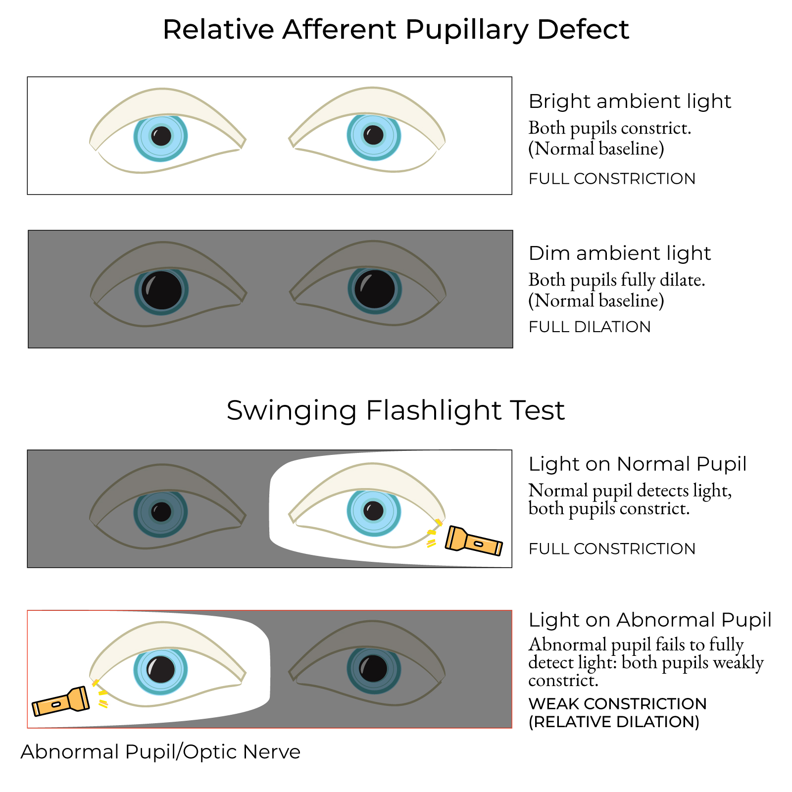 Relative Afferent Pupillary Defect (Marcus Gunn Pupil)