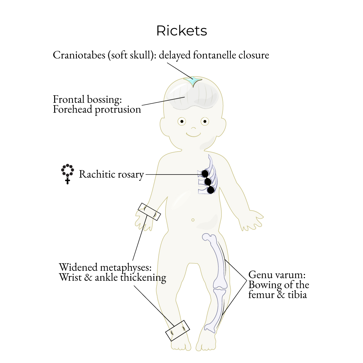 Rickets
