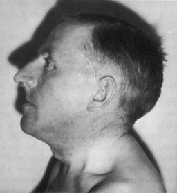 Basilar Invagination (Short Neck)