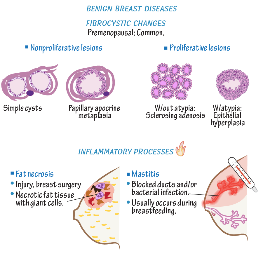 Benign Breast Diseases