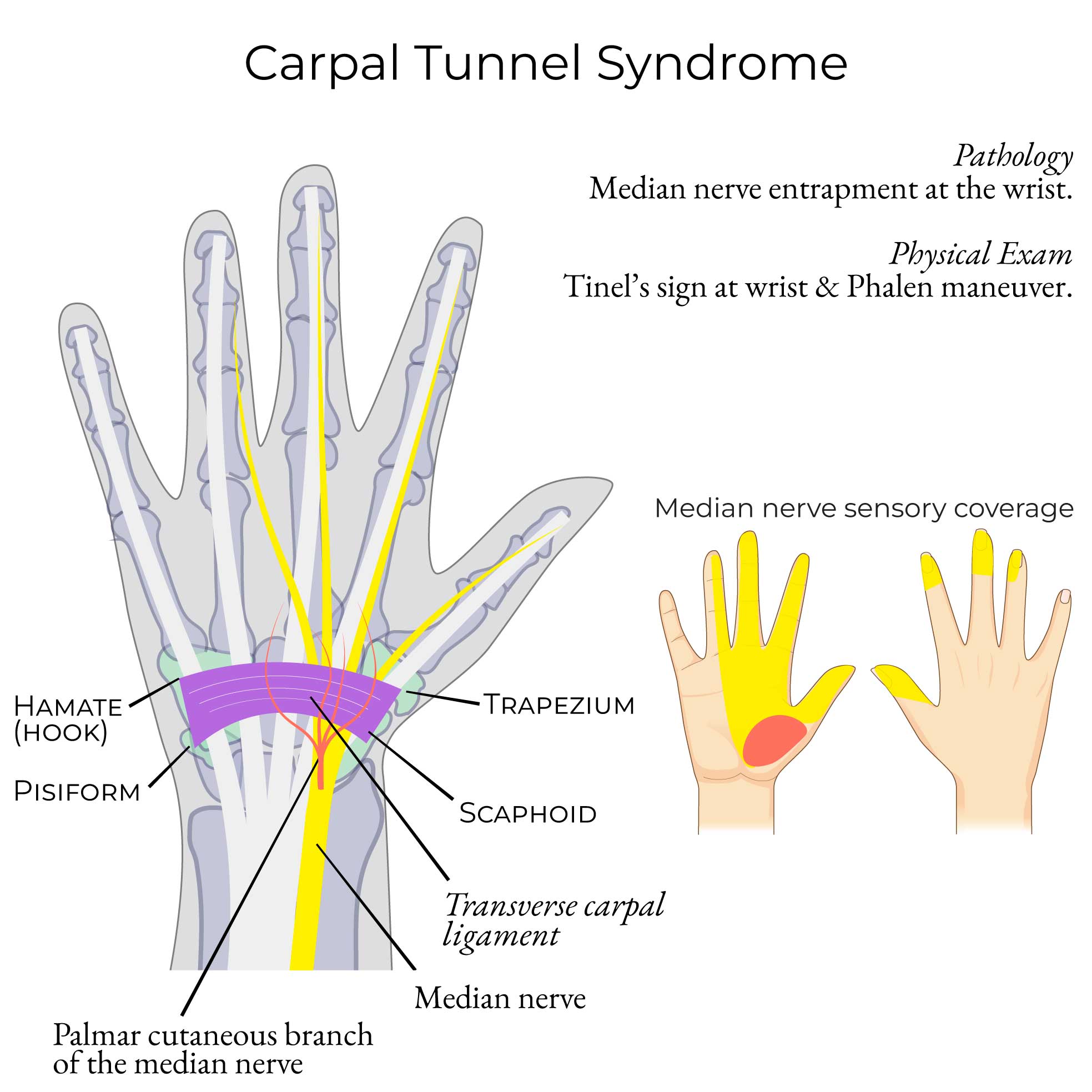 Carpal Tunnel Syndrome
