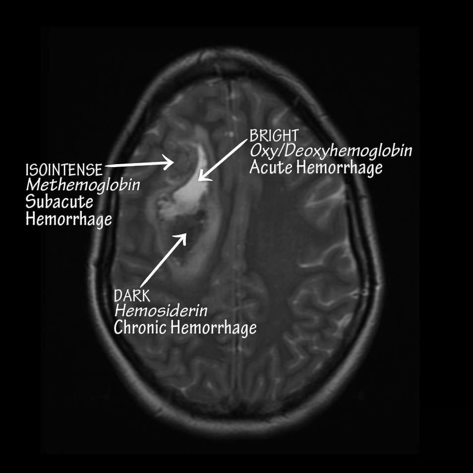 Causes & Locations of Intracerebral Hemorrhage