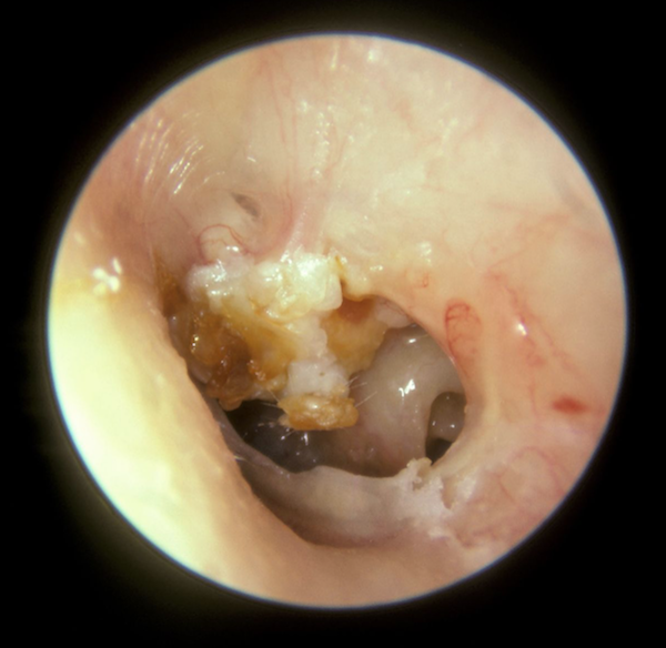Cholesteatoma