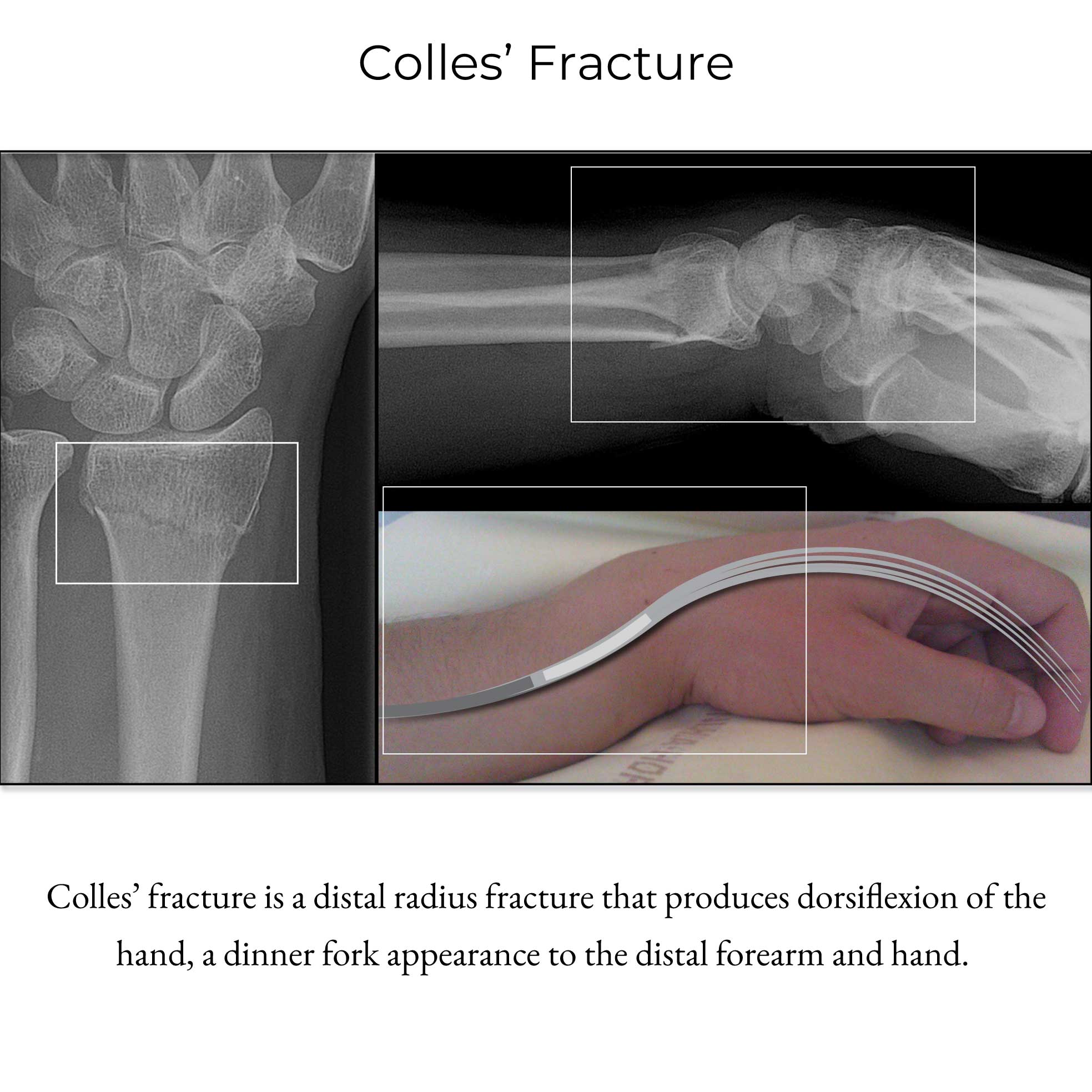 Colles' Fracture