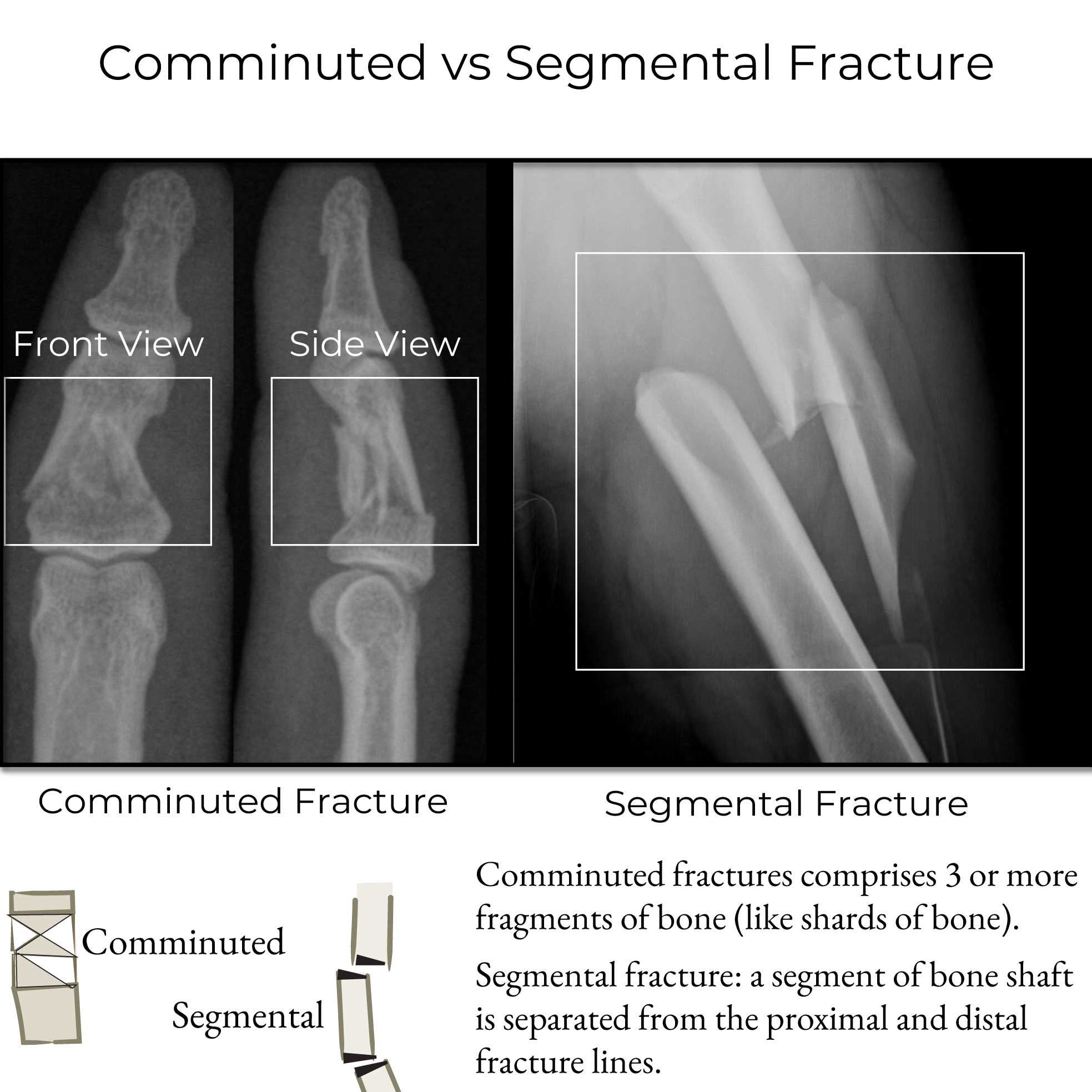 Comminuted vs Segmental Fracture