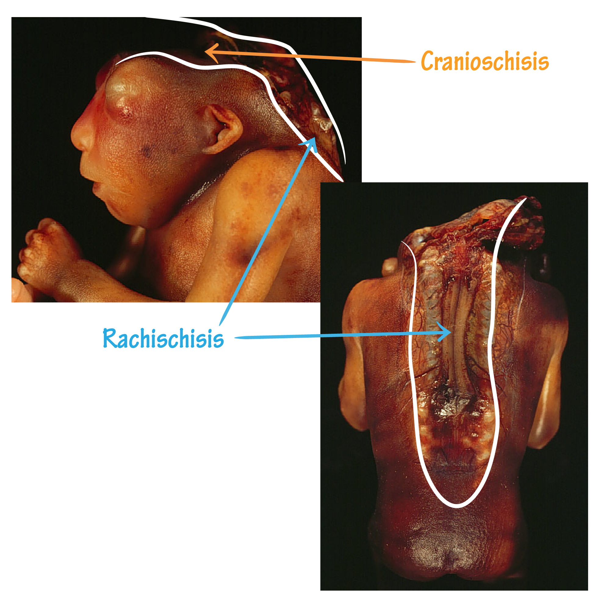 Craniorachischisis (aka total dysraphism)