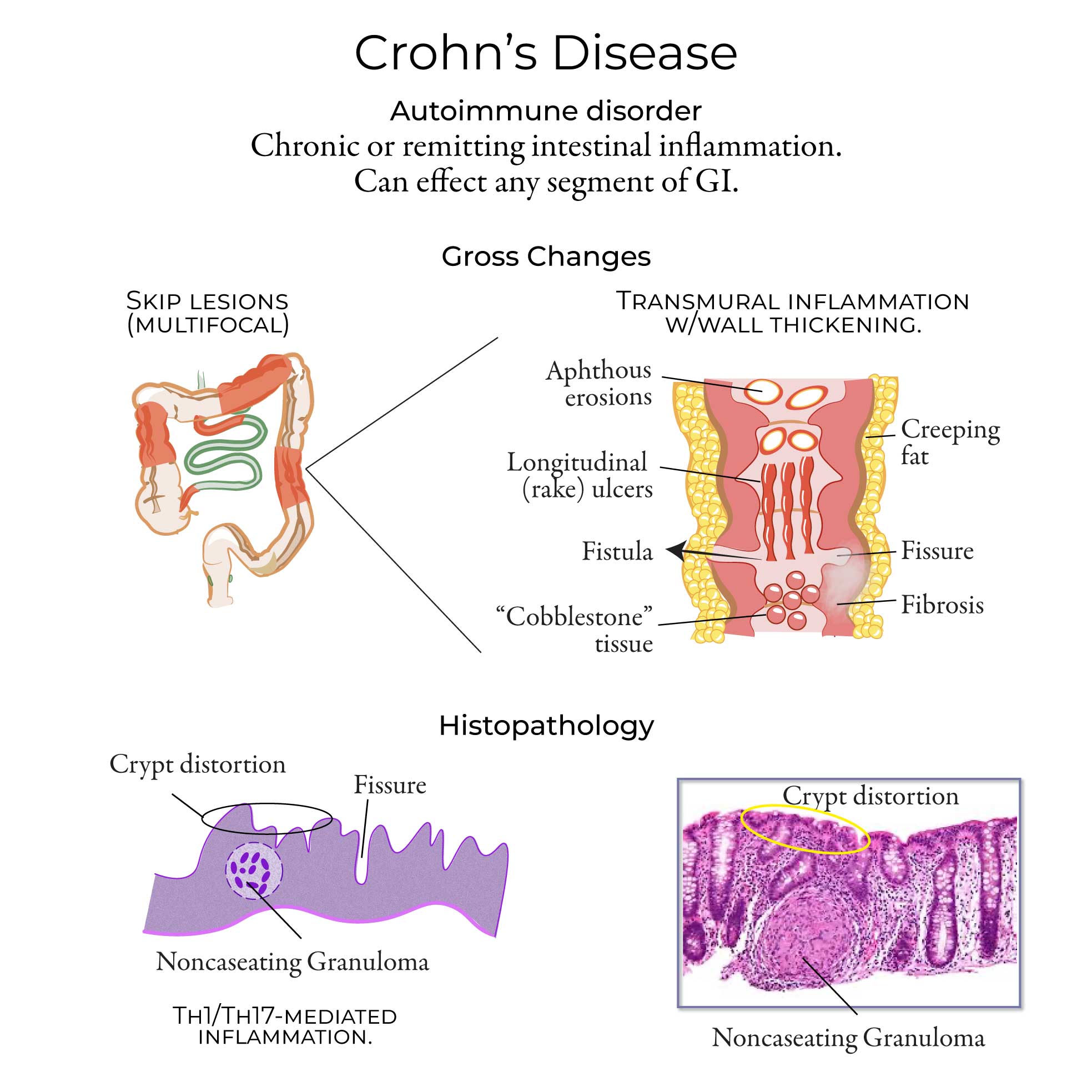 Crohn Disease