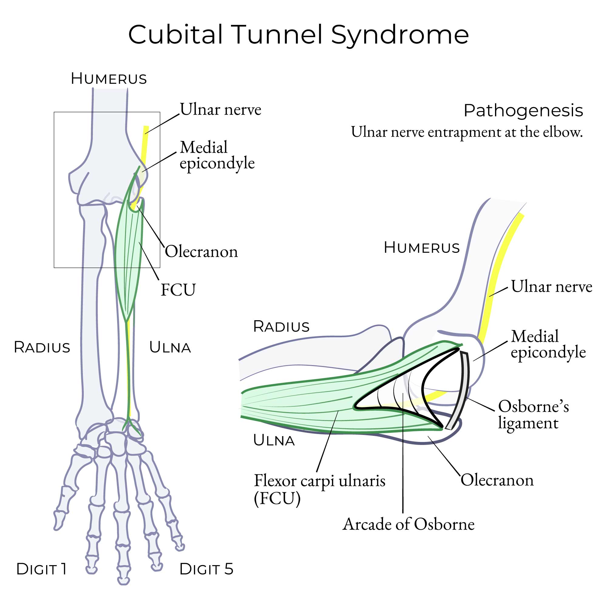 Cubital Tunnel Syndrome