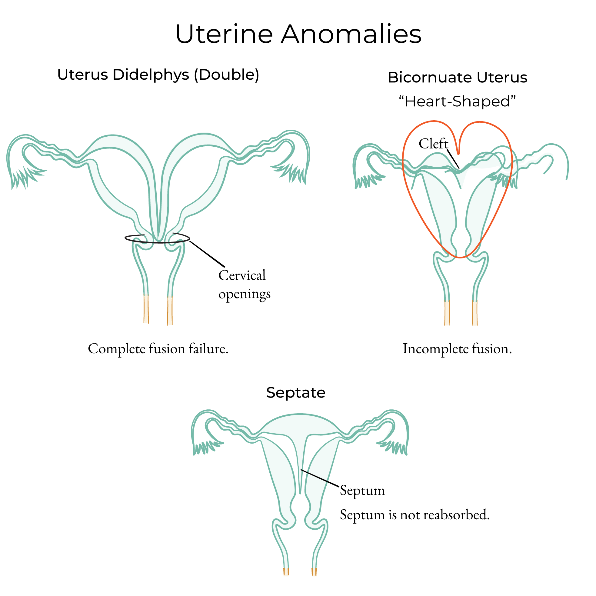 Uterine Anomalies
