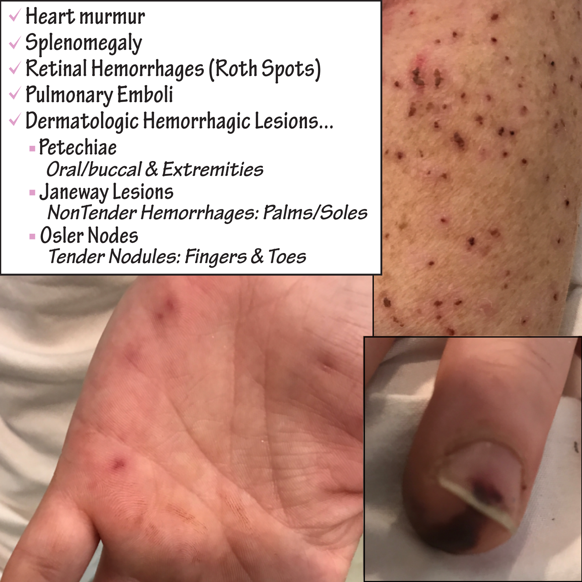 Endocarditis - Neurologic Manifestations