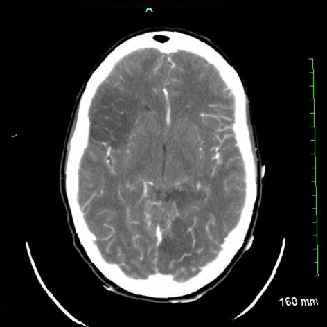 Endocarditis - Neurologic Manifestations