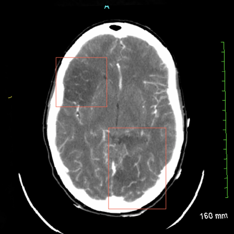 Endocarditis - Neurologic Manifestations