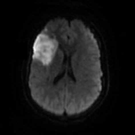 Endocarditis - Neurologic Manifestations
