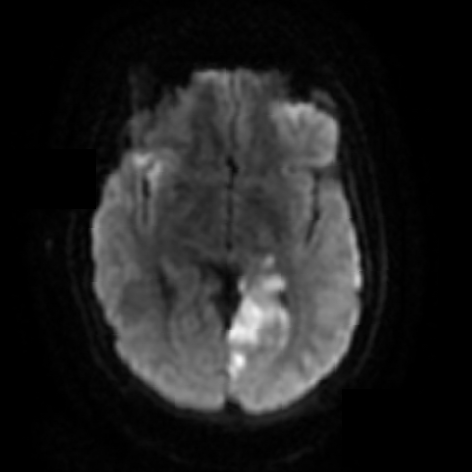 Endocarditis - Neurologic Manifestations