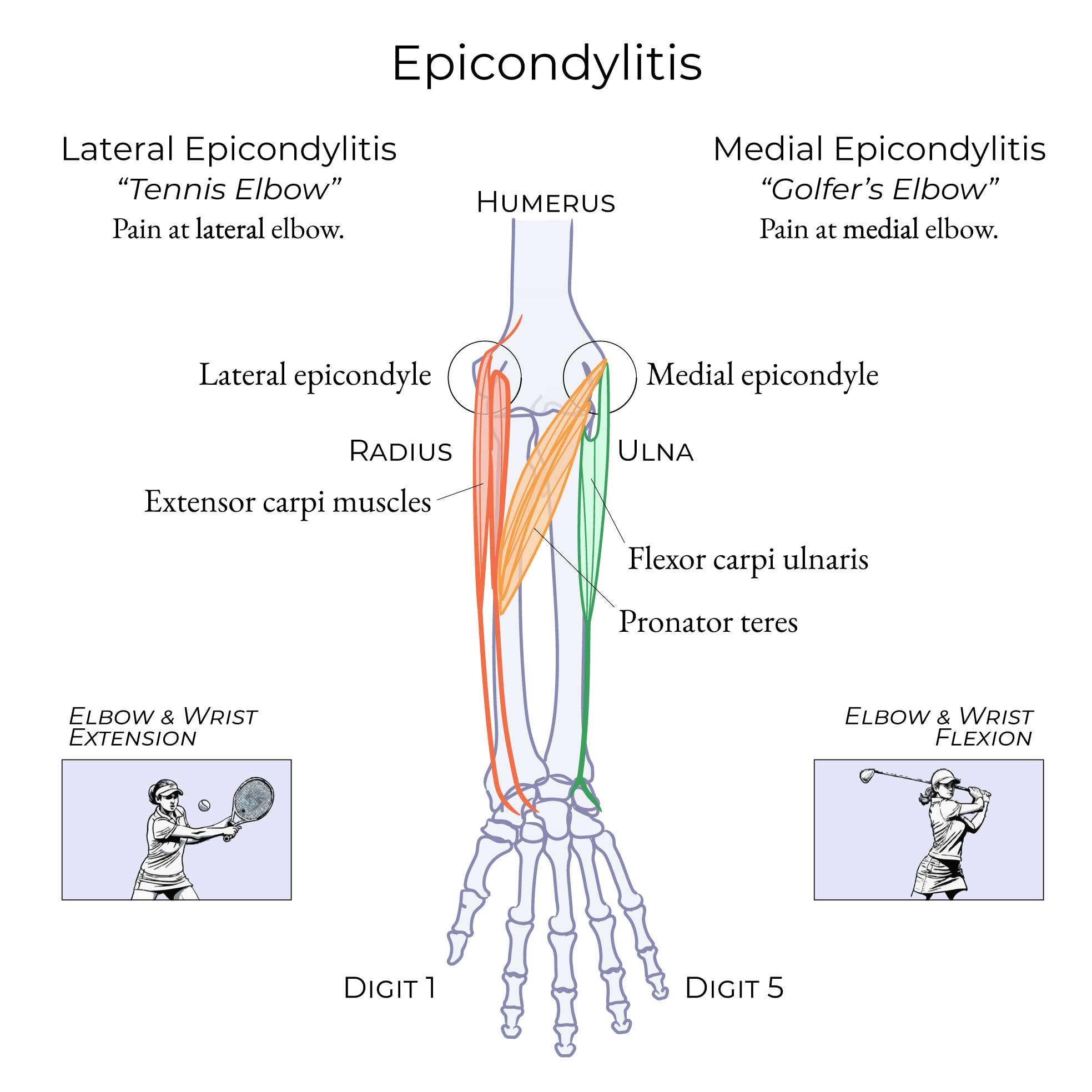 Epicondylitis (Lateral & Medial)