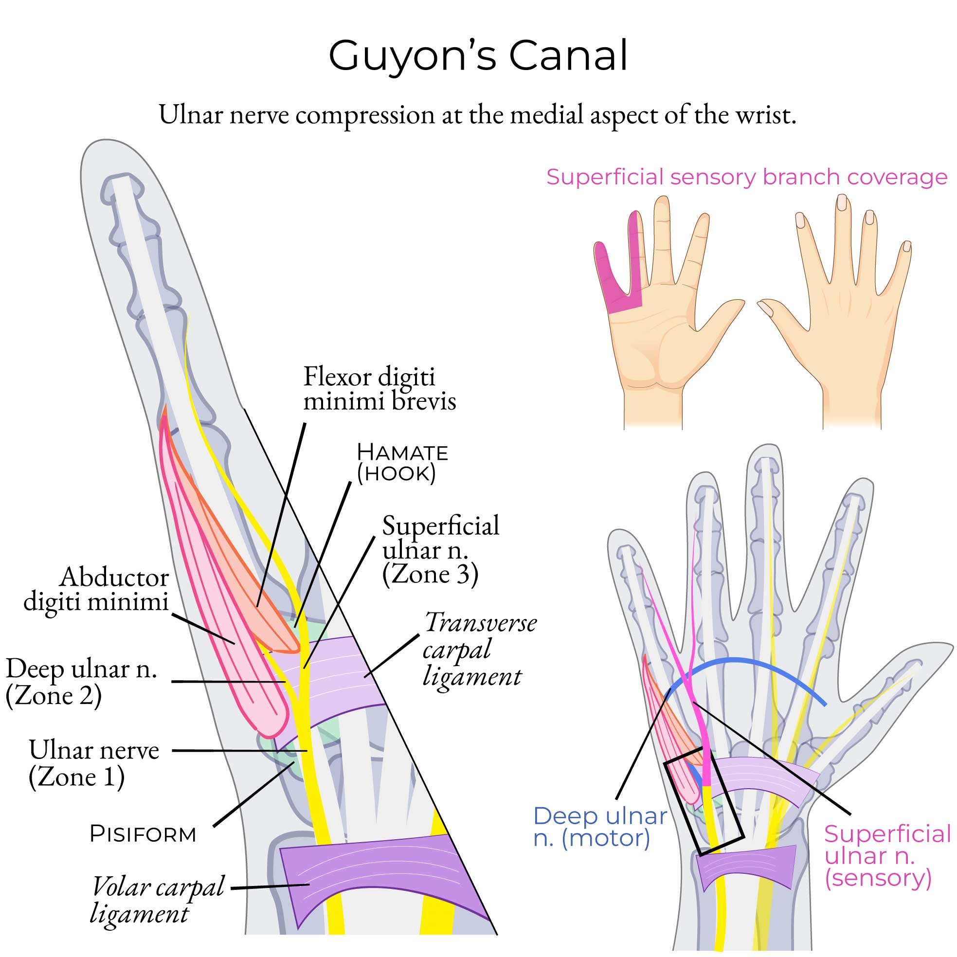 Guyon's Canal Syndrome