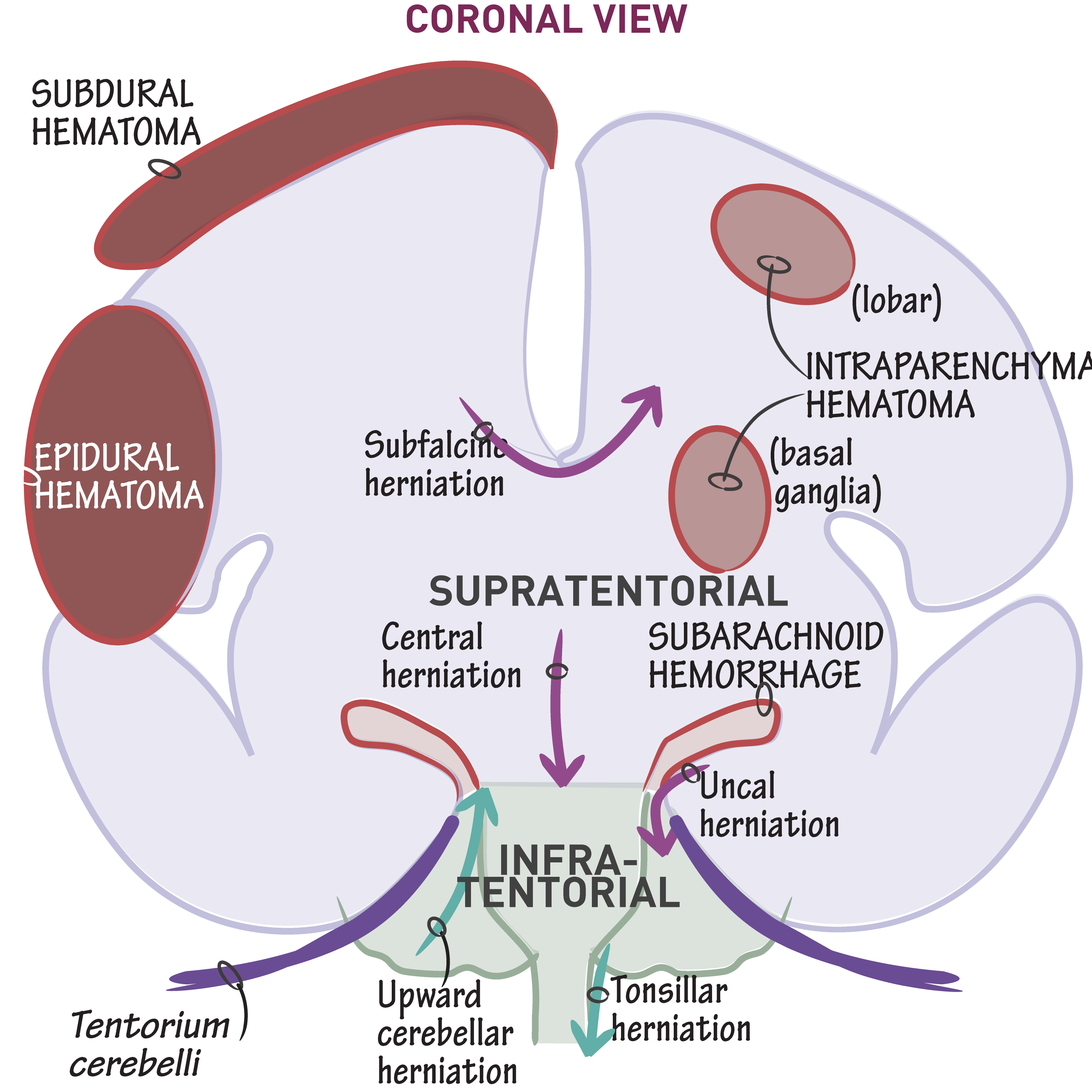 Herniations & Hemorrhages