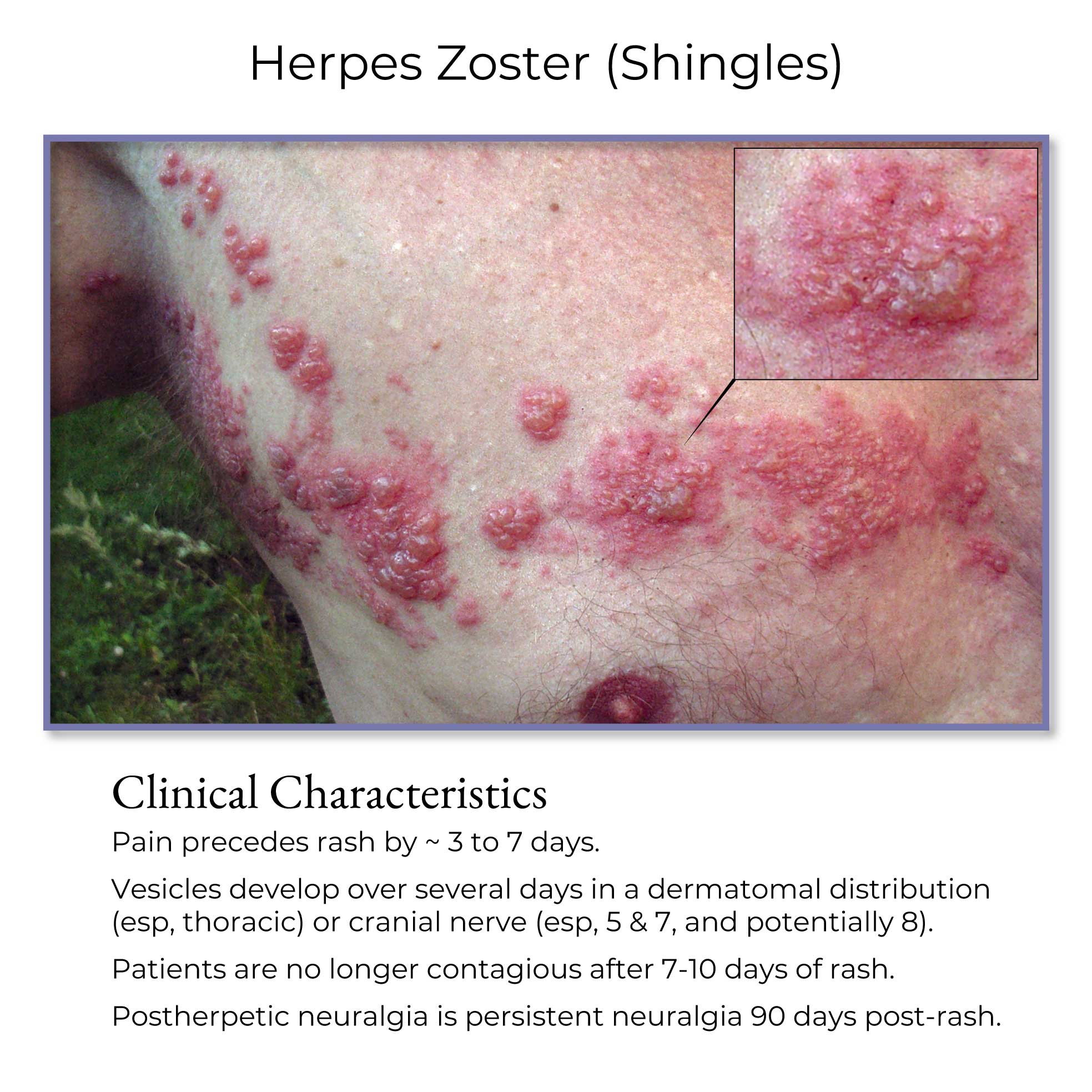 Clinical Pathology Glossary Herpes Zoster Shingles Ditki Medical Clinical Pathology Glossary Herpes Zoster Shingles Ditki Medical