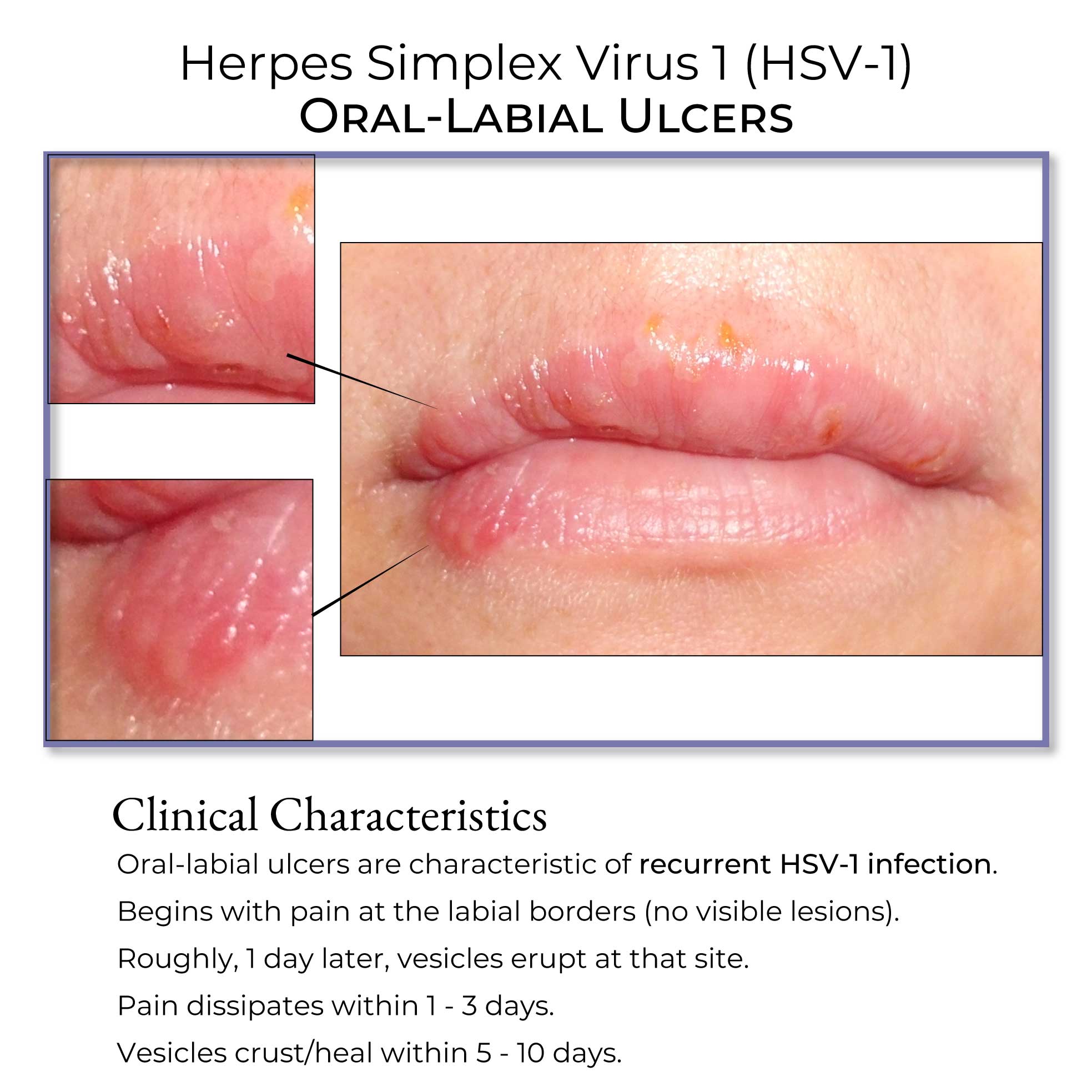 Clinical Pathology Glossary HSV 1 Oral Labial Ulcers Ditki Medical Clinical Pathology Glossary HSV 1 Oral Labial Ulcers Ditki Medical