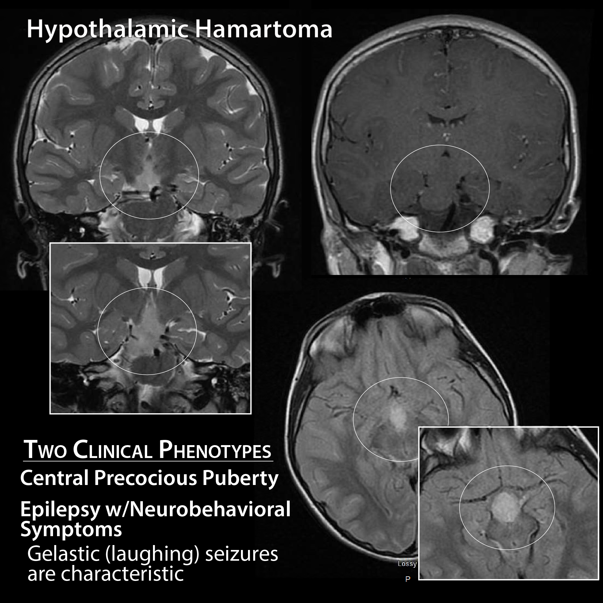 Hypothalamic Hamartoma