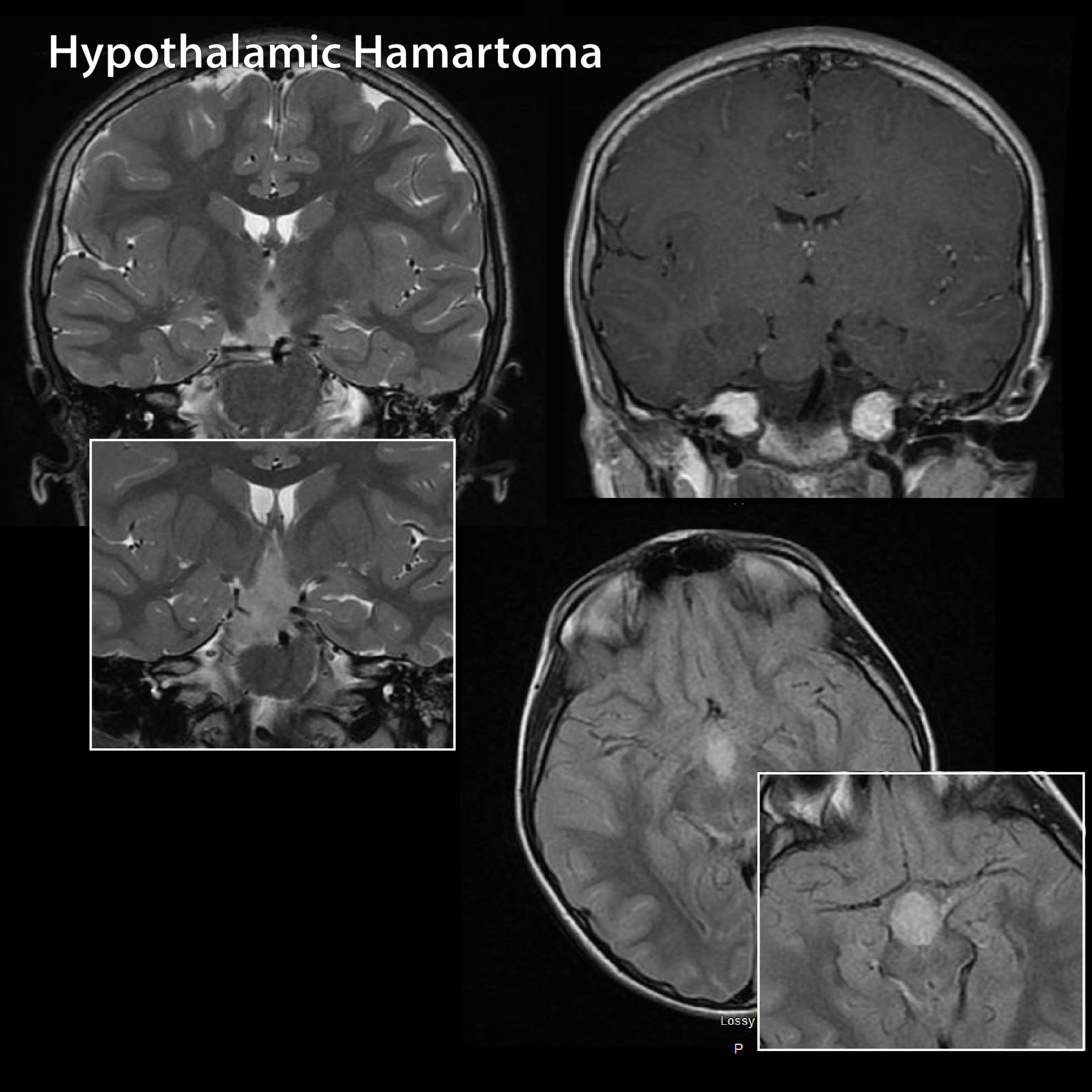 Hypothalamic Hamartoma