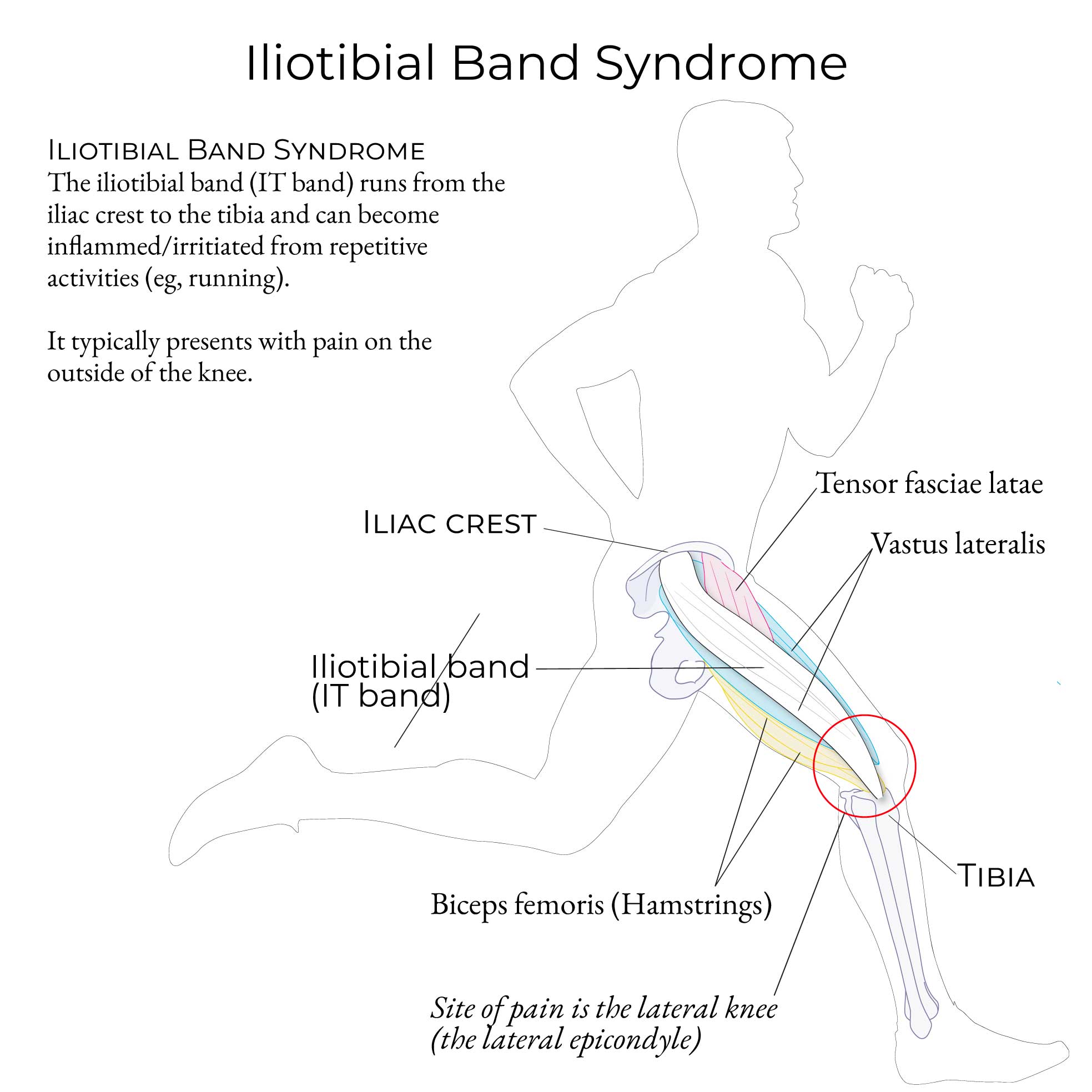 Iliotibial band (IT band) syndrome