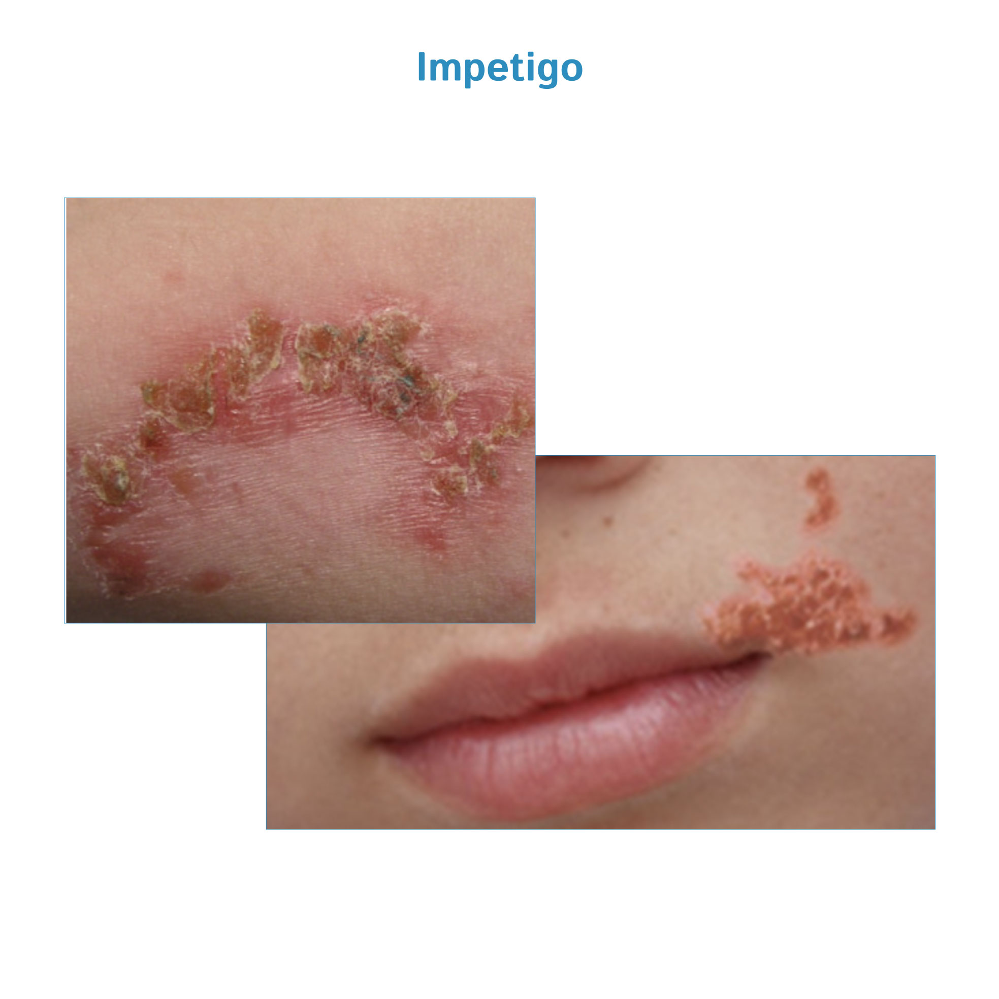Impetigo
