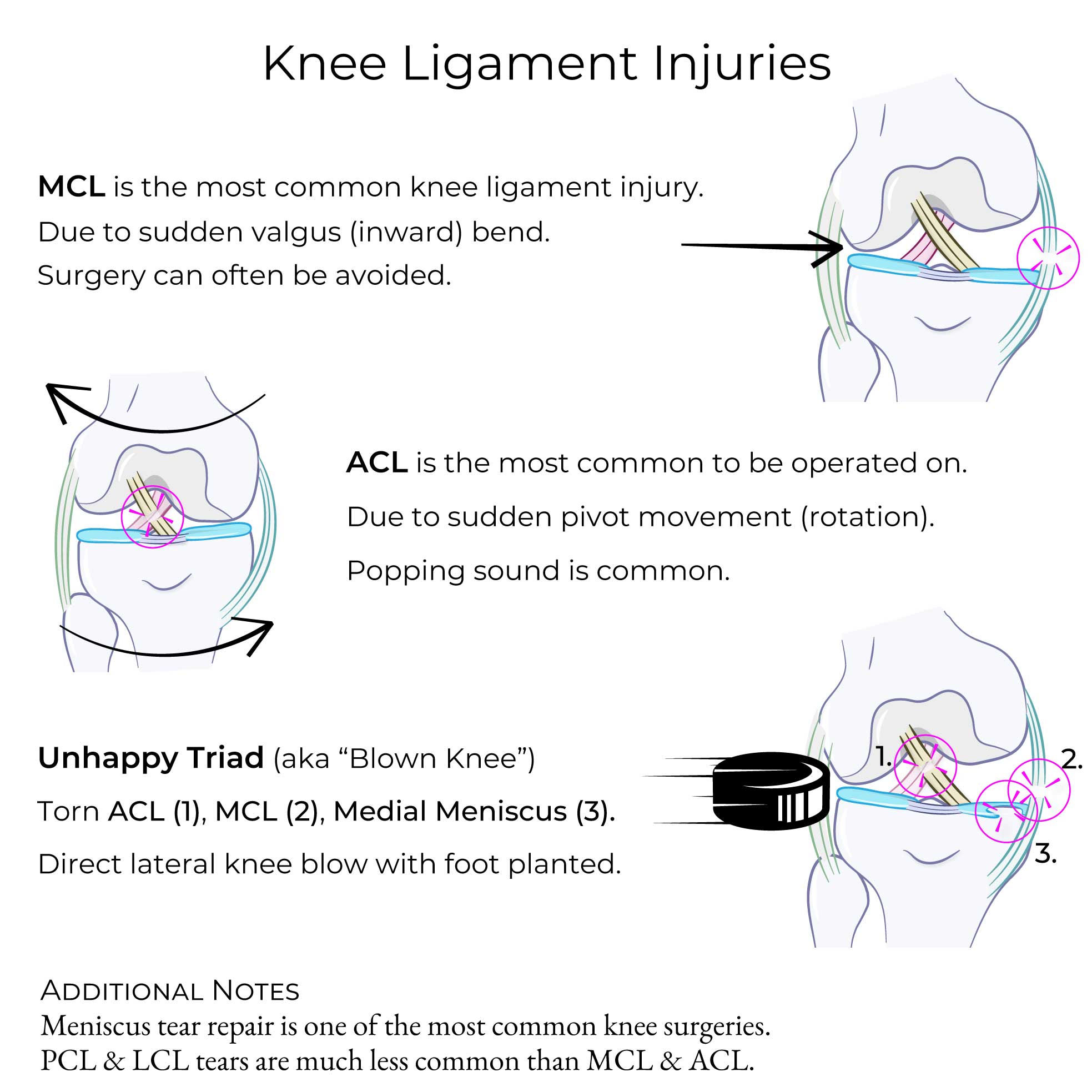 Knee Ligament Injuries (MCL, ACL, Unhappy Triad)