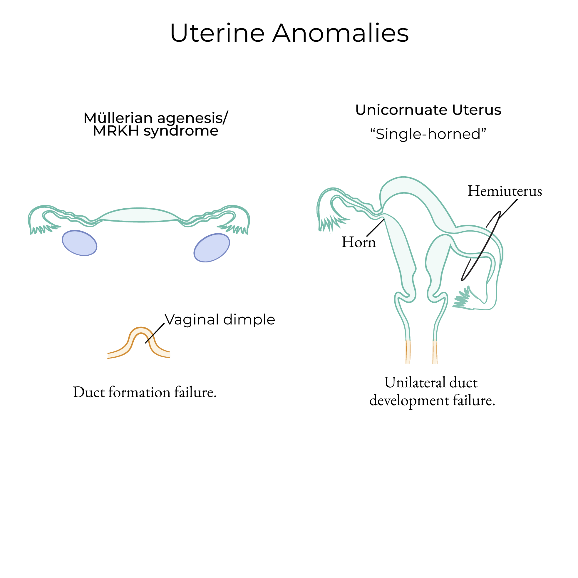 Uterine Anomalies
