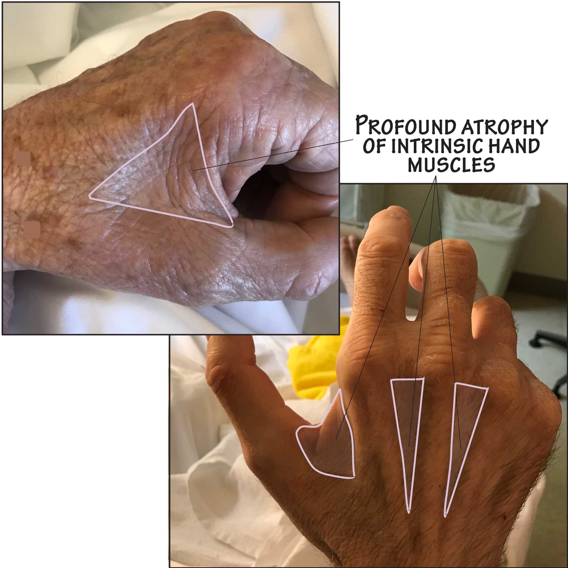 Muscle Wasting: Distal Extremities