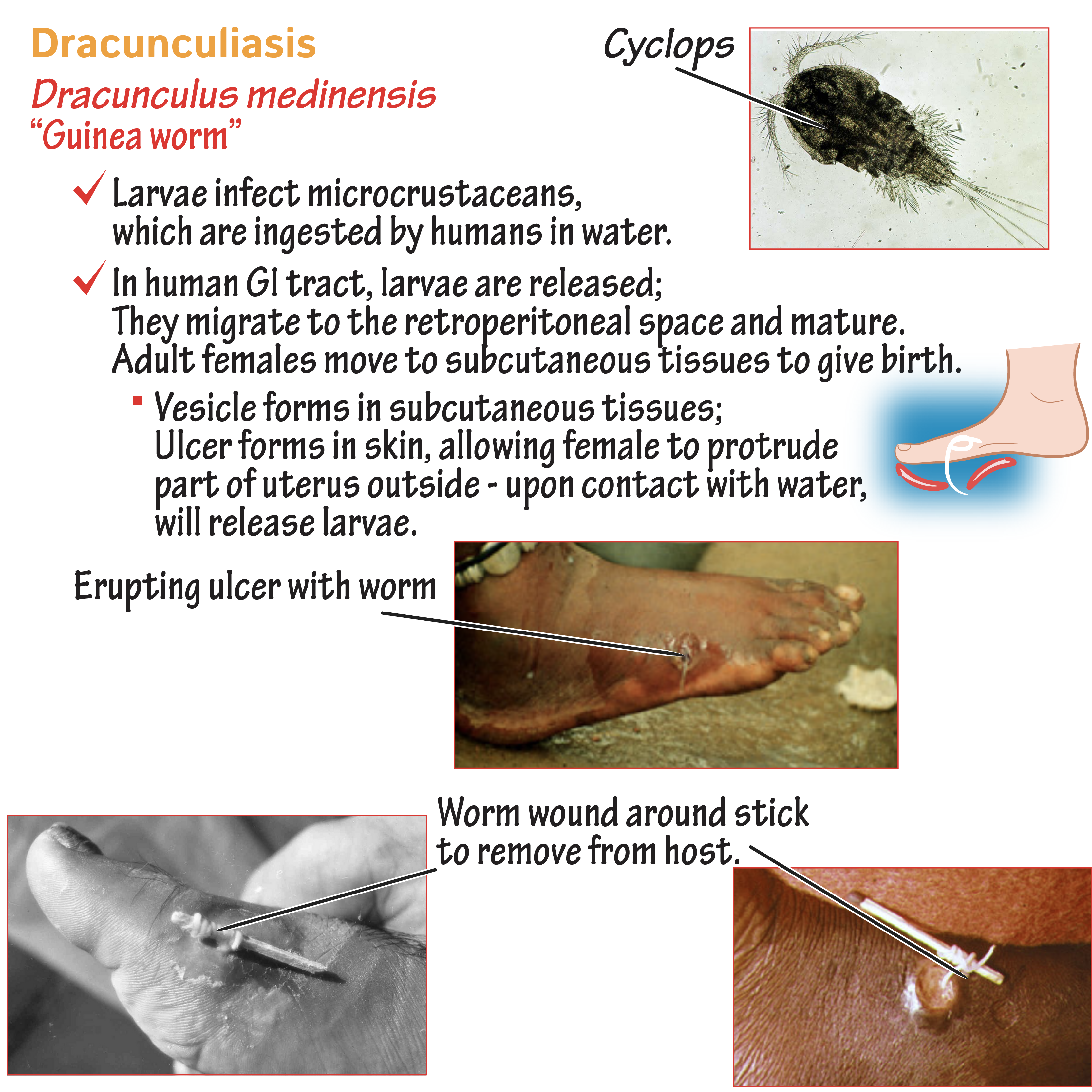 Nematode - Dracunculus medinensis