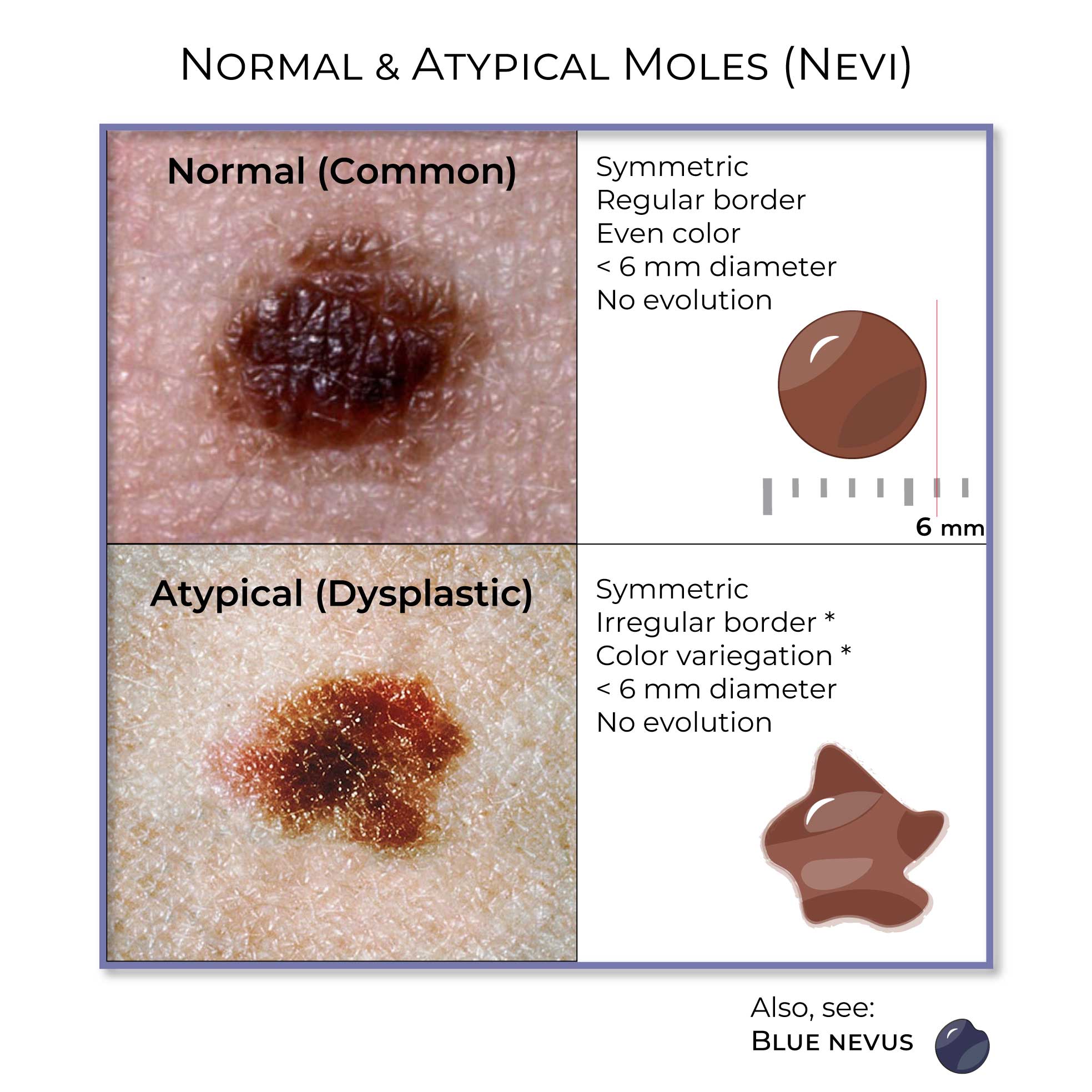 Names Of Cancerous Moles Can You Spot Which Moles Are Deadly The Skin