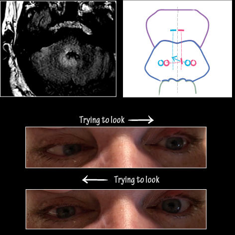 One-and-a-half Syndrome
