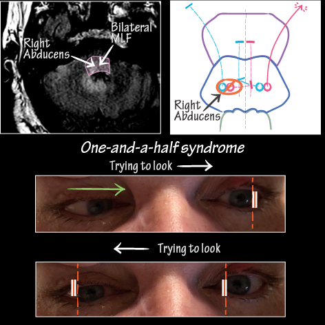 One-and-a-half Syndrome