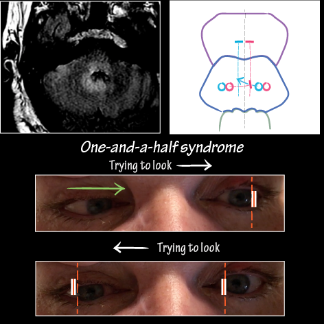 One-and-a-half Syndrome