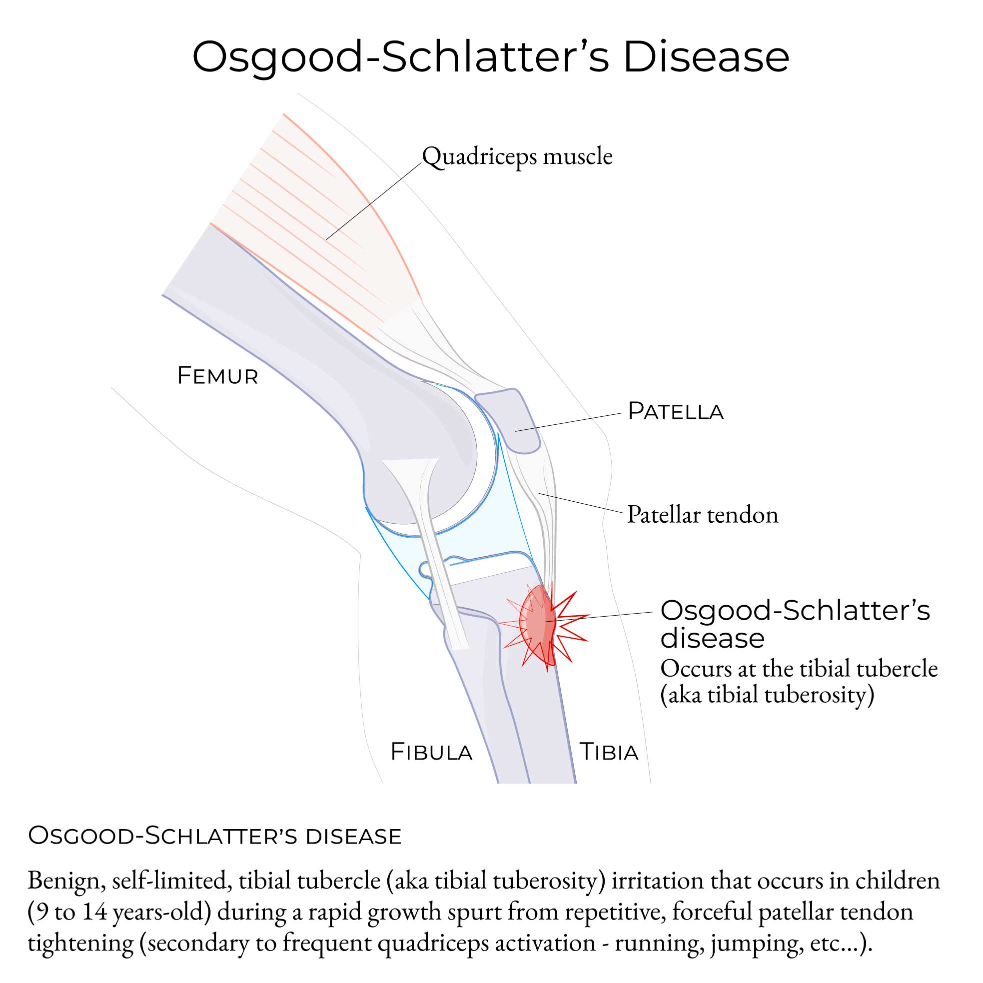 Osgood-Schlatter disease