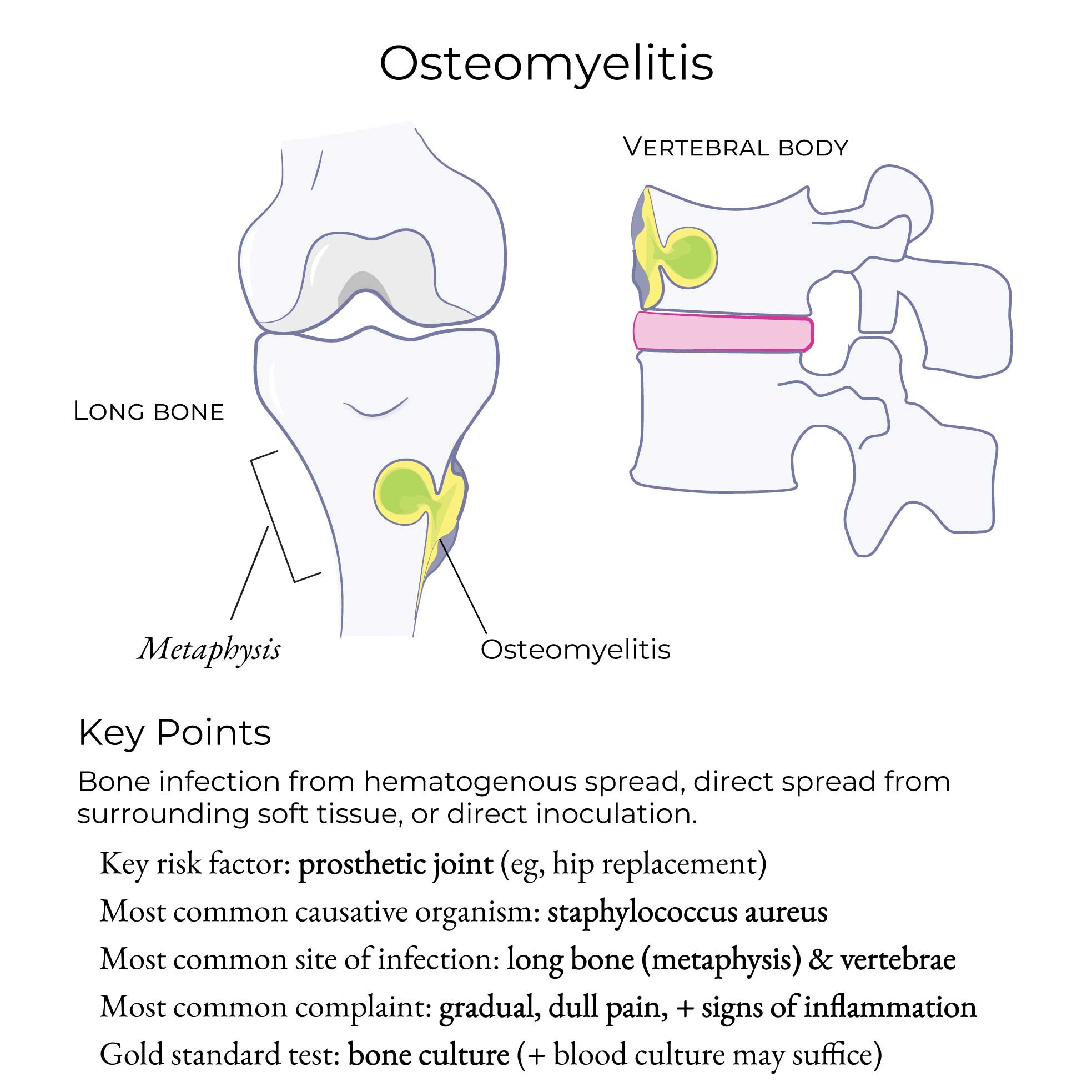 Osteomyelitis