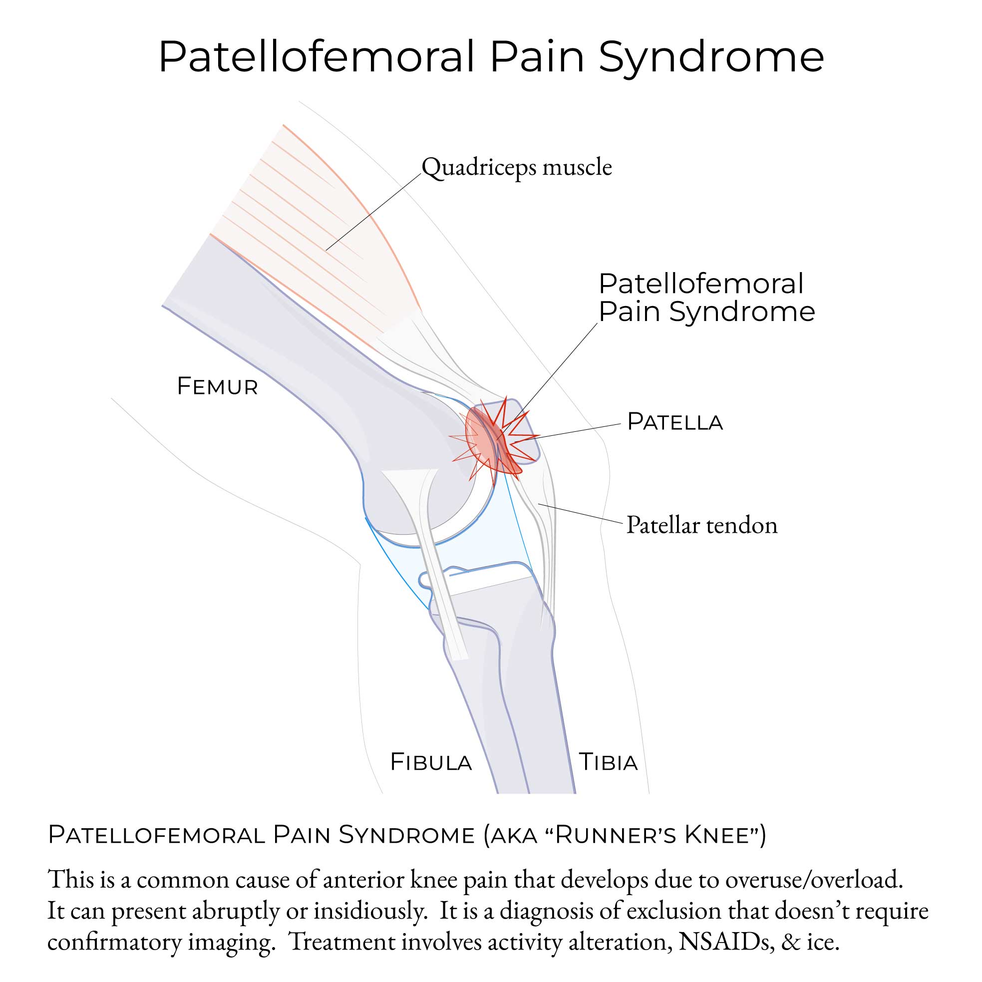 Patellofemoral Pain Syndrome (aka "Runner's Knee")