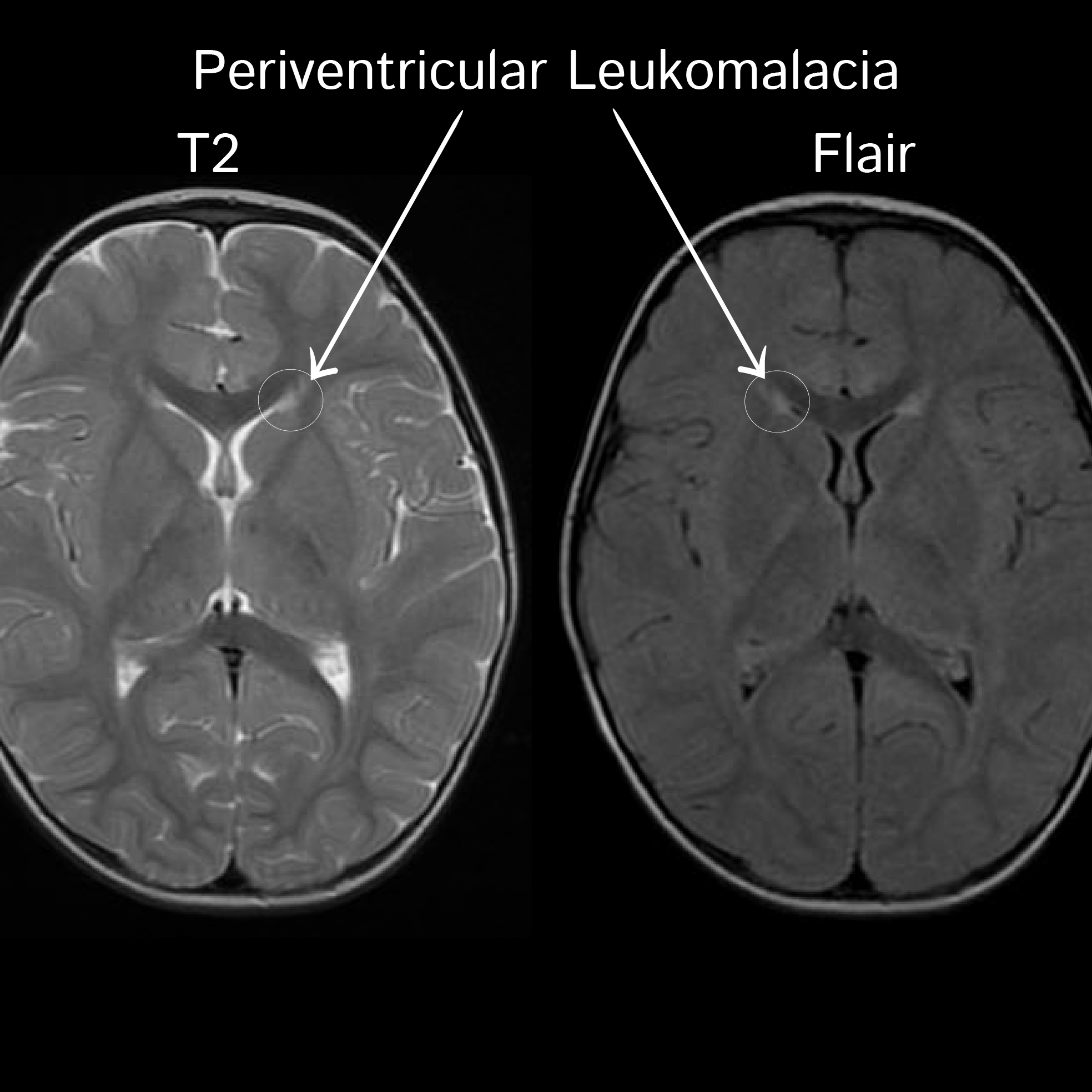 Clinical Pathology Glossary Periventricular Leukomalacia Ditki 