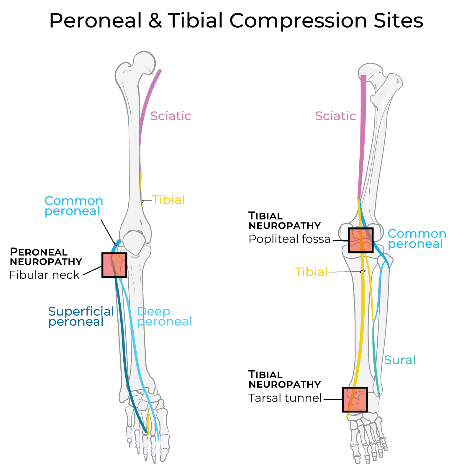 Common Peroneal Nerve (aka Fibular Nerve)