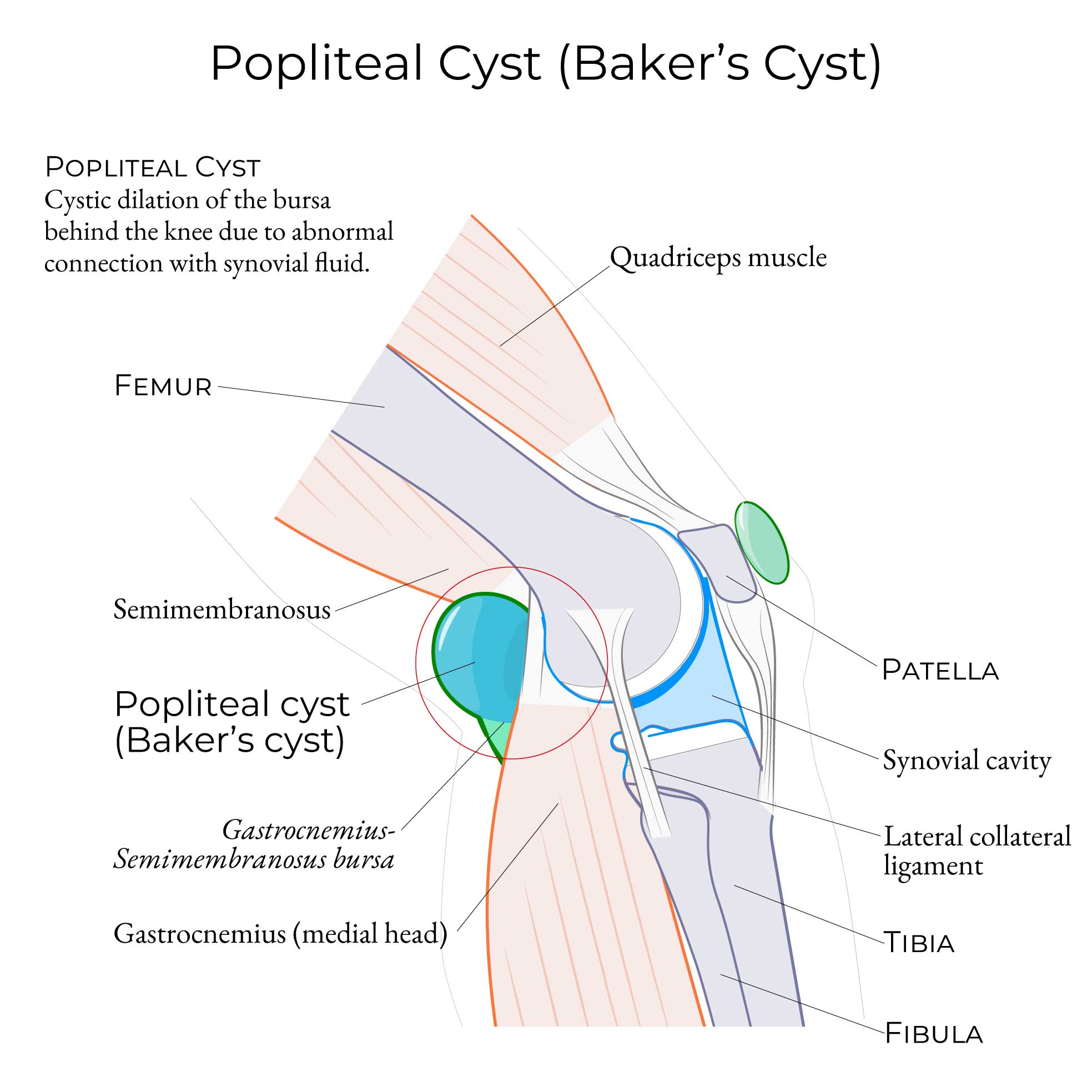 Popliteal cyst (Baker's Cyst)